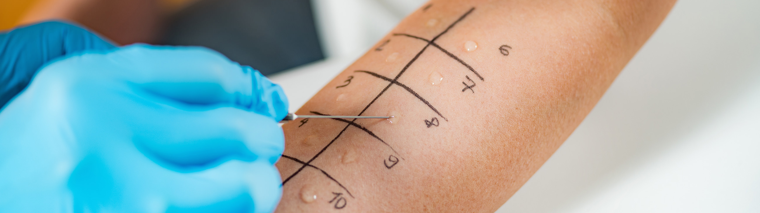 Identifying the cause of eczema through allergy tests