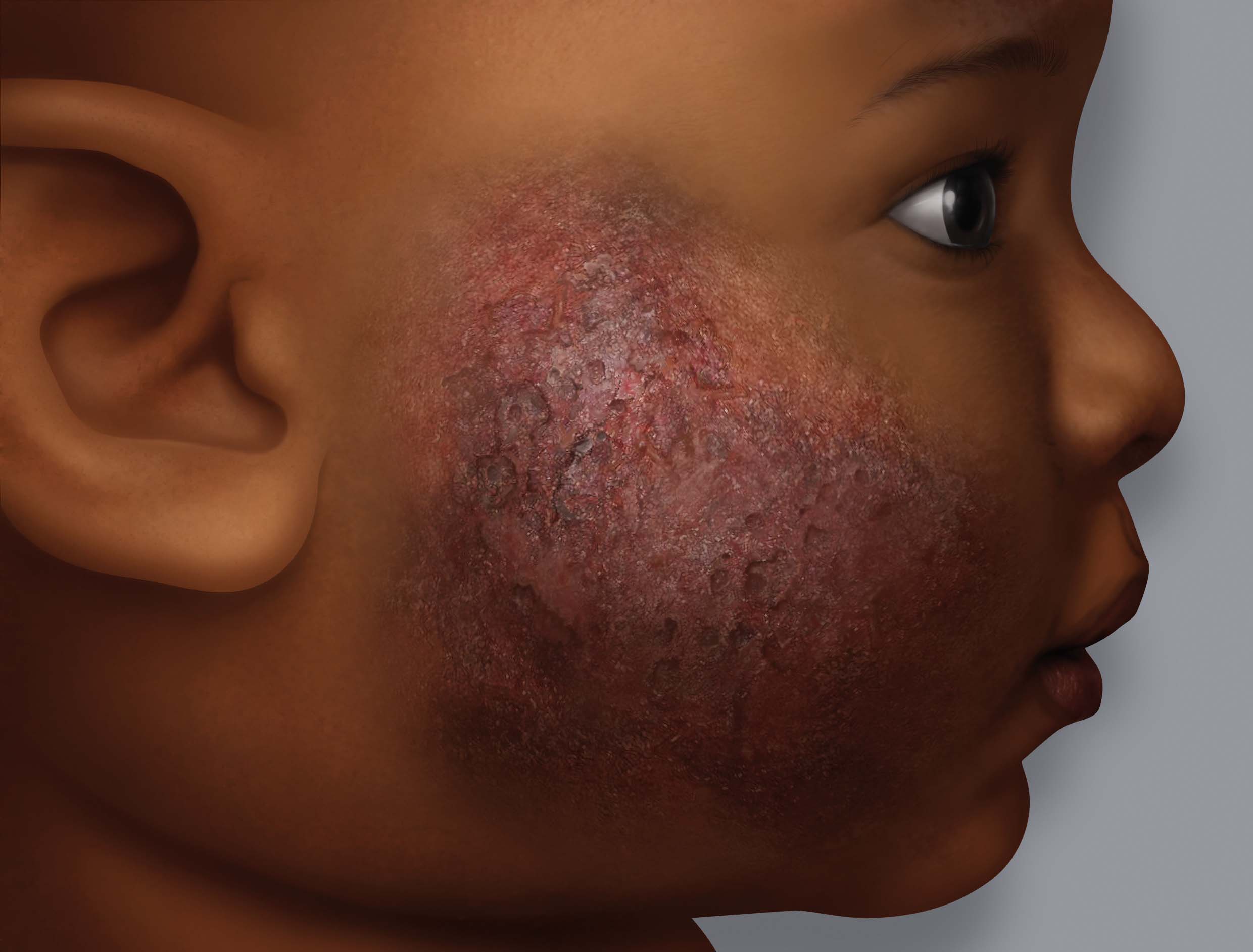 Symptome von Ekzemen auf dunkler Haut: Nässen (Bläschen - Krusten)