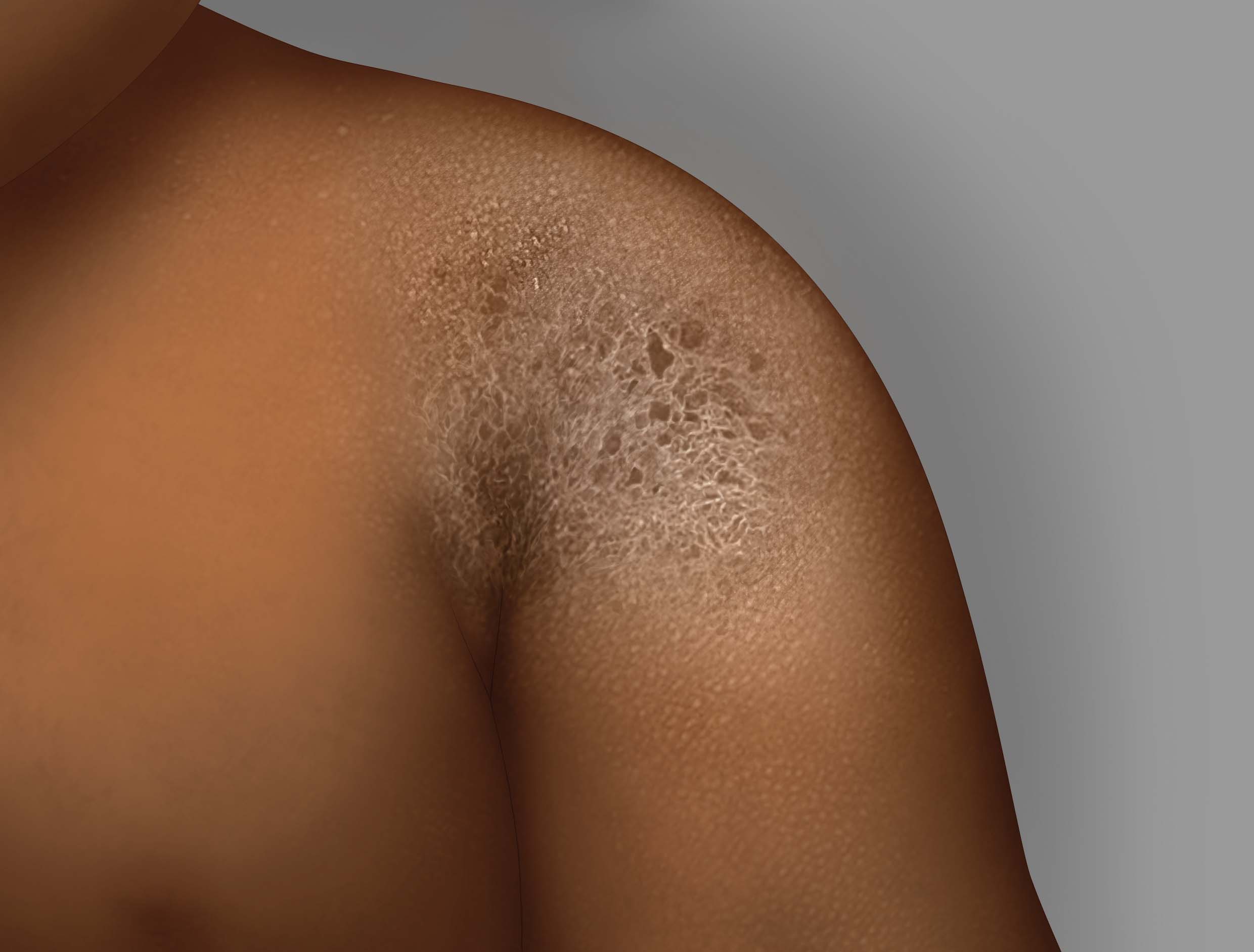 Symptome von Ekzemen auf dunkler Haut: trockene bis sehr trockene Haut (Xerosis)