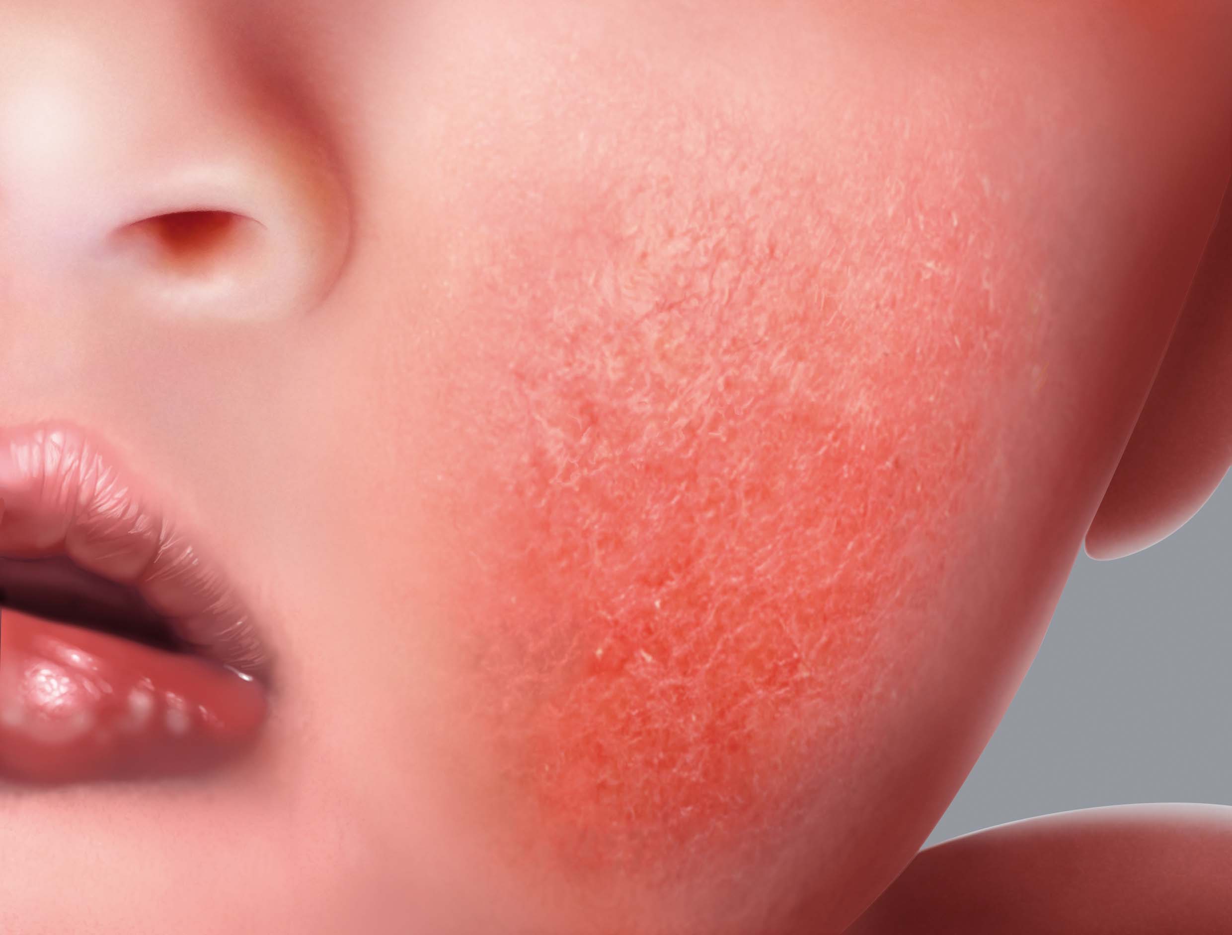 Síntomas del eczema atópico: placas rojas o eritema