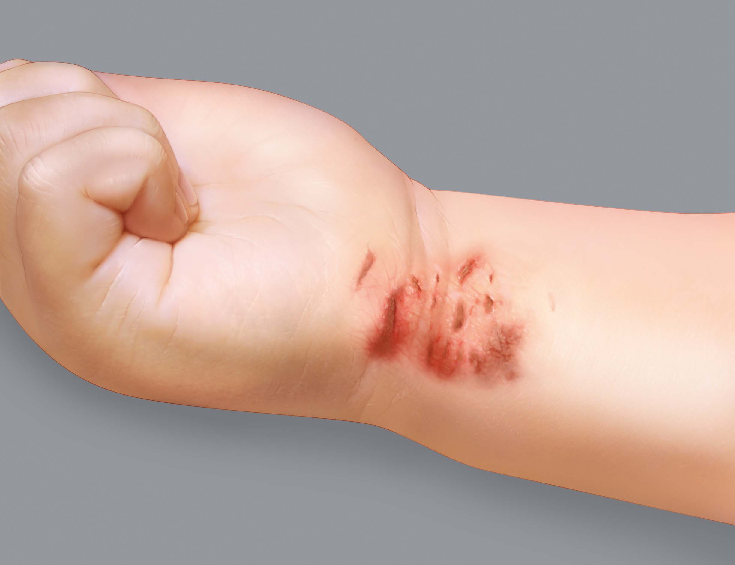 Atopic eczema symptoms: marks from scratching or excoriation
