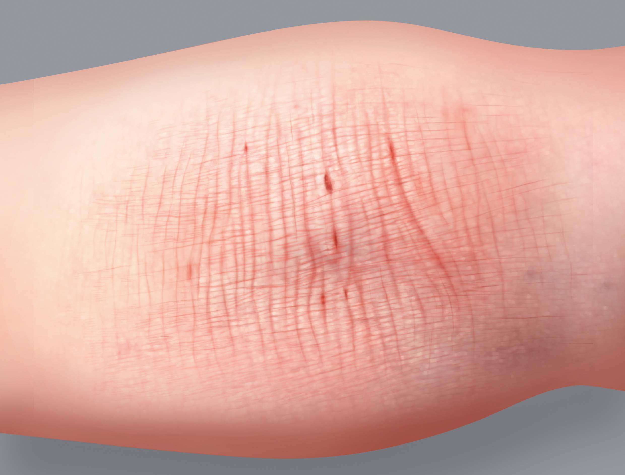 Sintomas do eczema atópico: espessamento de pele ou liquenificação
