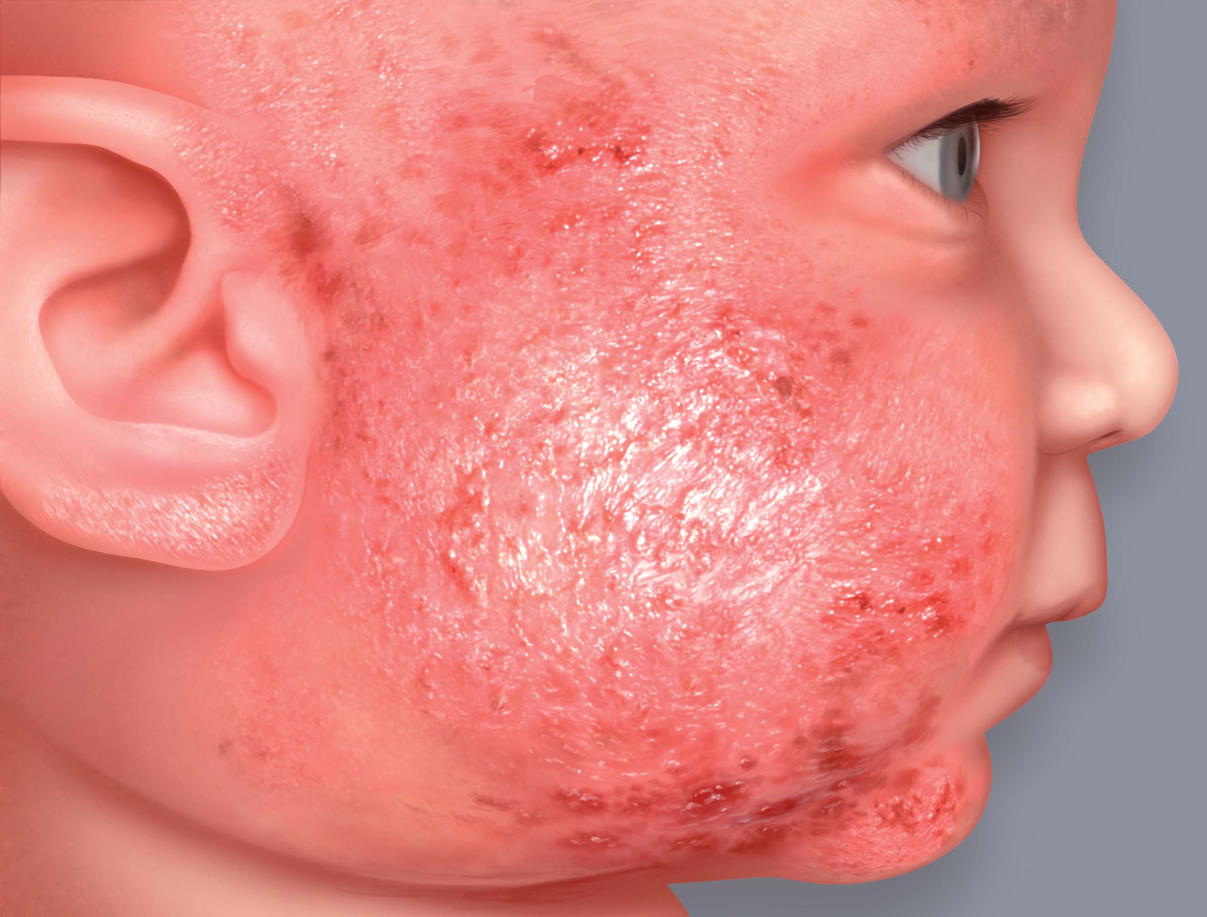 Atopic eczema symptoms: oozing (vesicles, crusting)