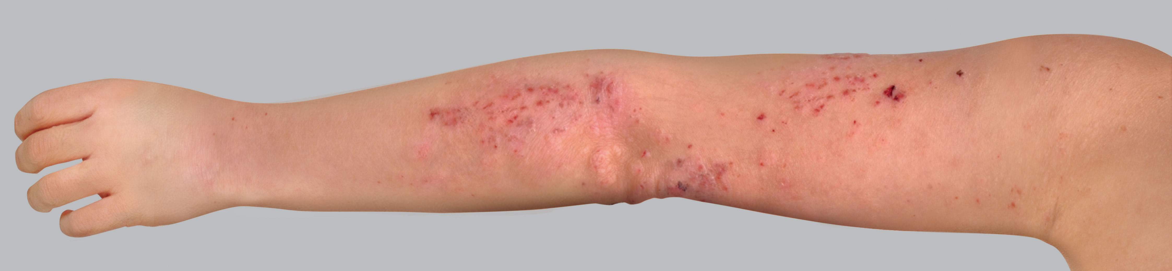 Atopic eczema symptoms: marks from scratching or excoriation