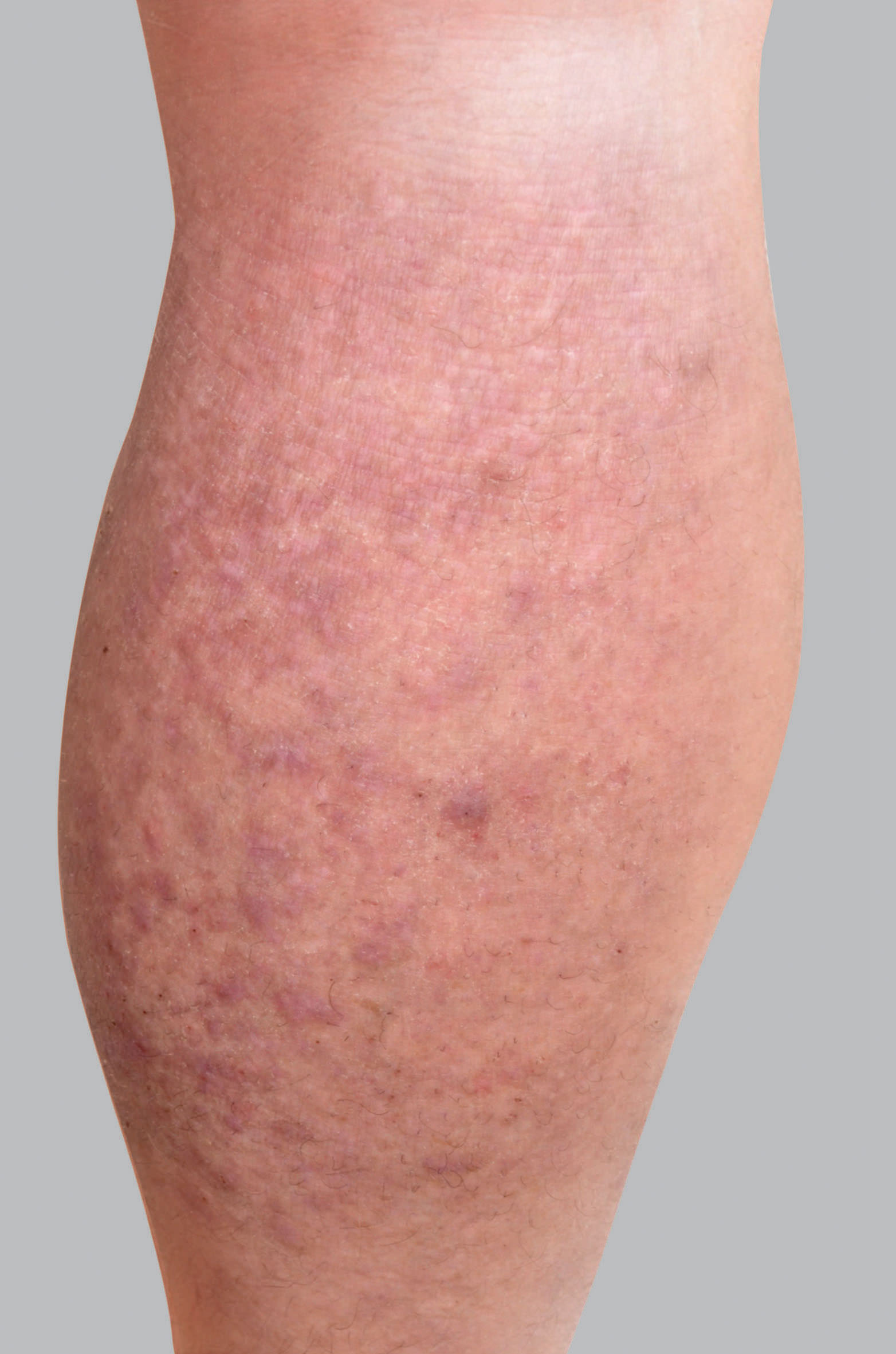Sintomas do eczema atópico: pápulas