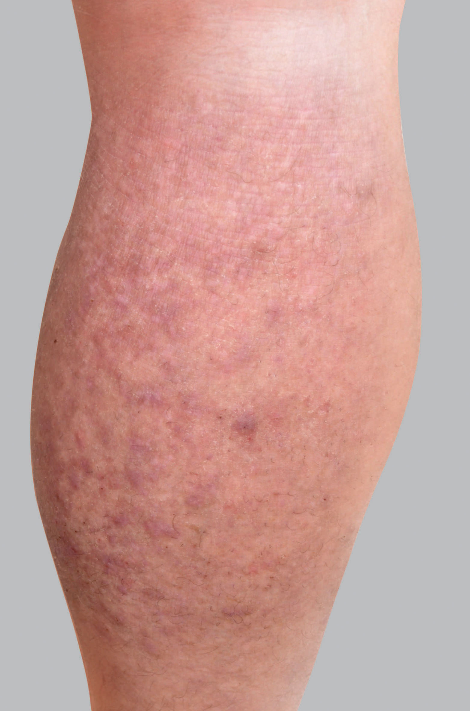 Sintomi dell'eczema atopico: papule