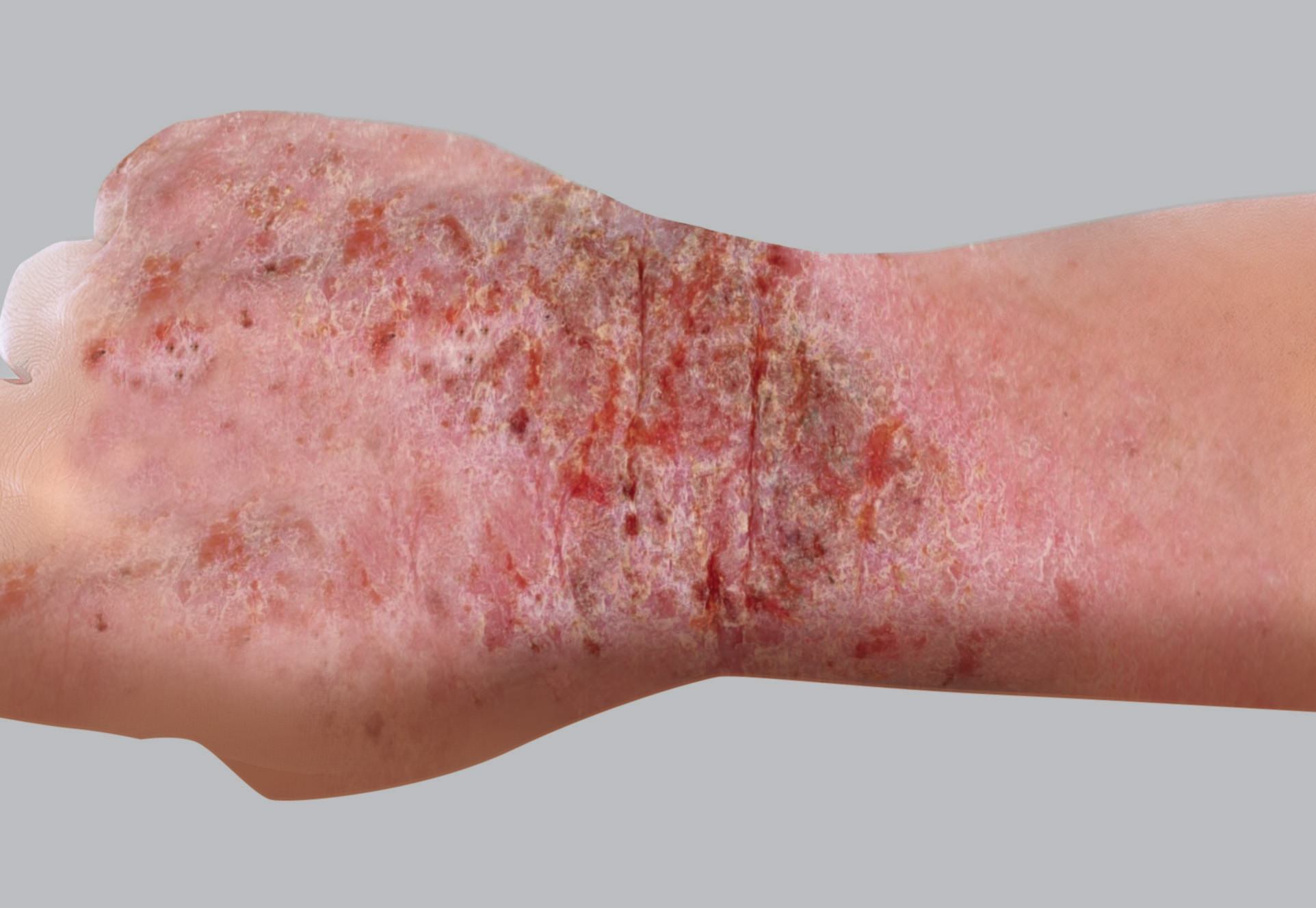 Sintomas do eczema atópico: exsudação (vesículas - crostas)
