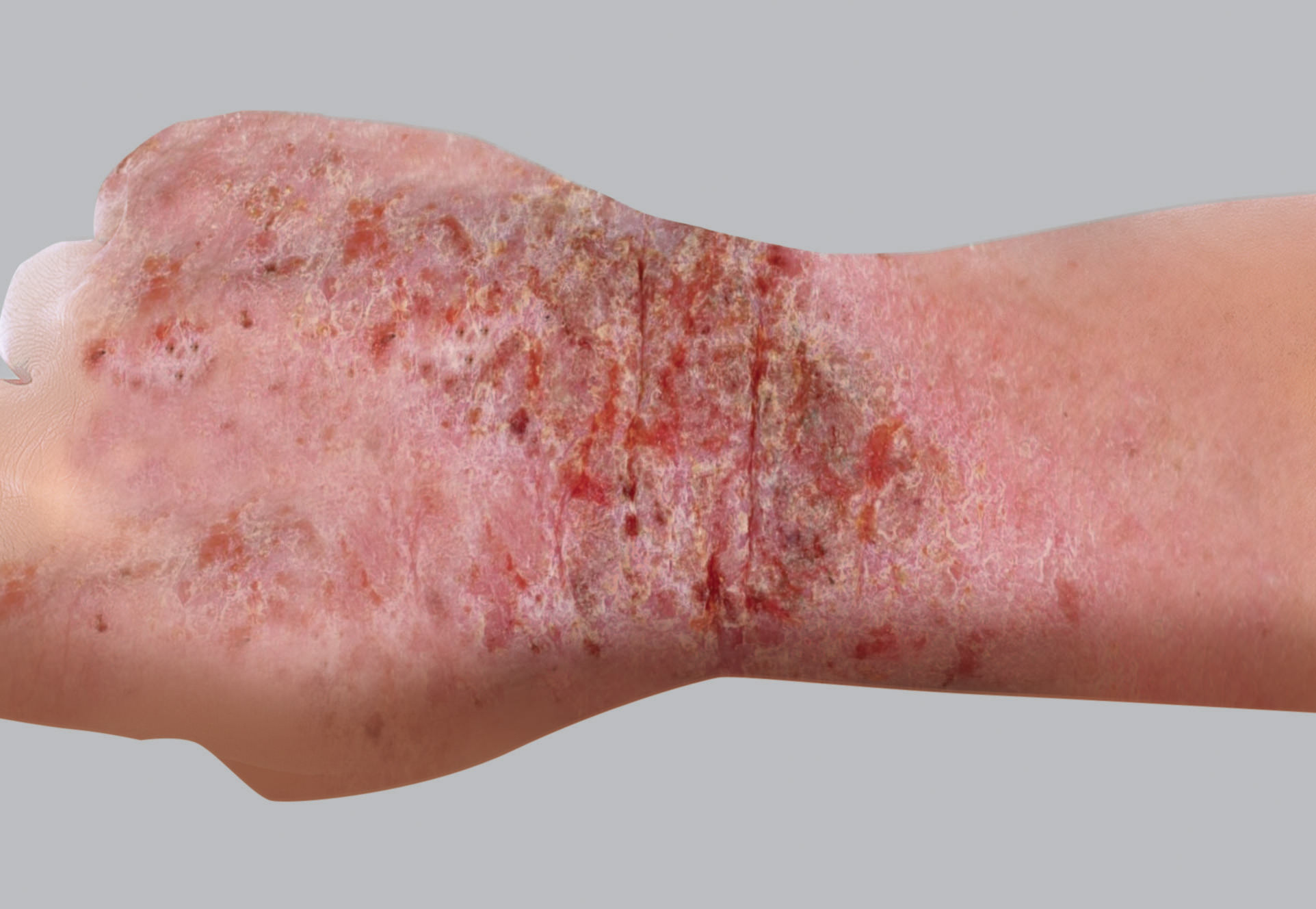 Síntomas del eczema atópico: supuración (vesículas - costras)