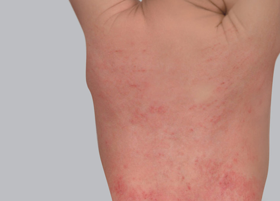 Síntomas del eczema atópico: placas rojas o eritema