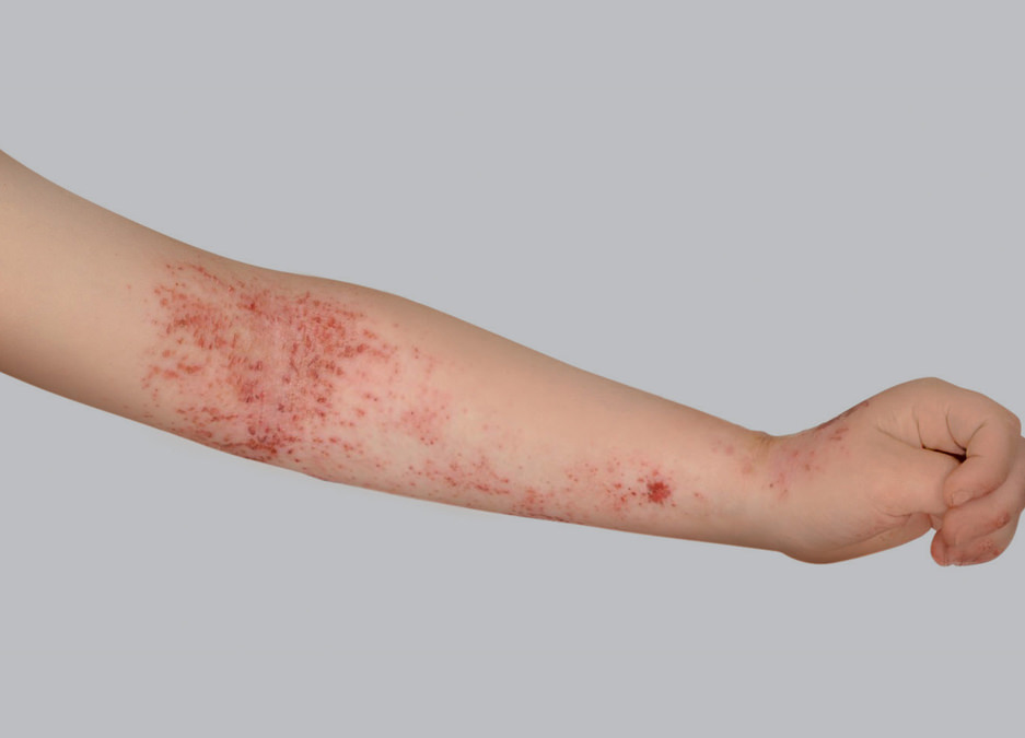 Sintomi dell'eczema atopico: lesioni da grattamento o escoriazioni