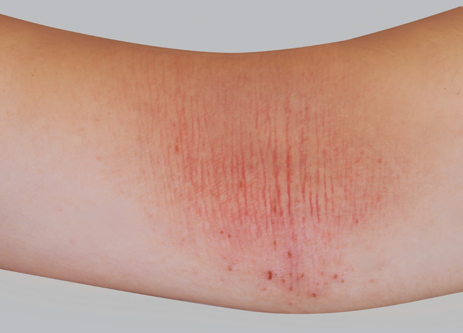 Atopic eczema symptoms: thickening of the skin or lichenification