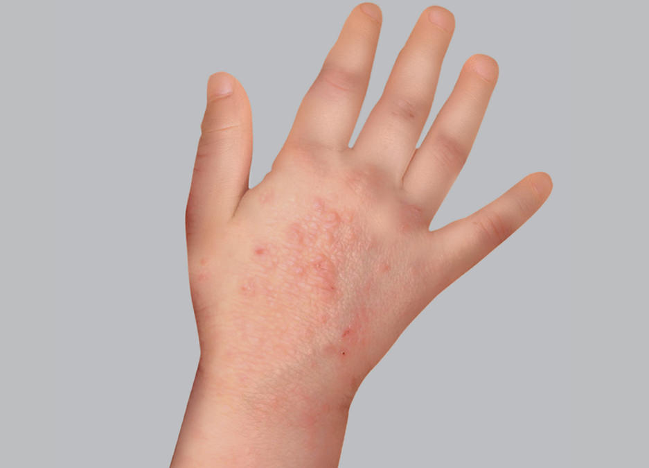 Síntomas del eczema atópico: papulación