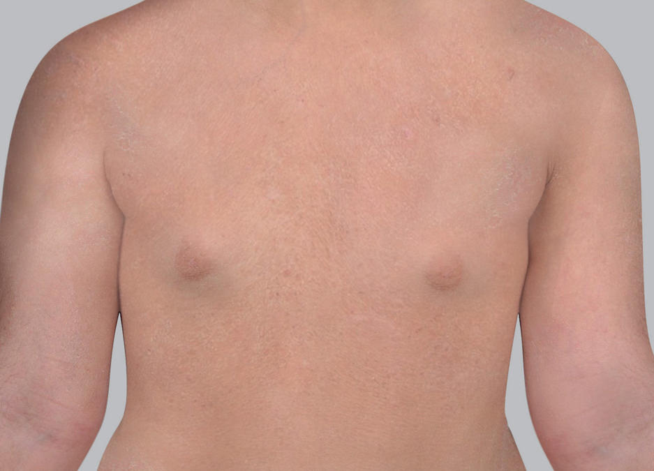 Sintomi dell'eczema atopico: pelle da secca a molto secca o xerosi