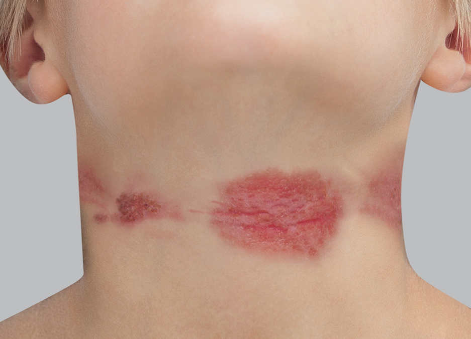 Síntomas del eczema atópico: supuración (vesículas - costras)
