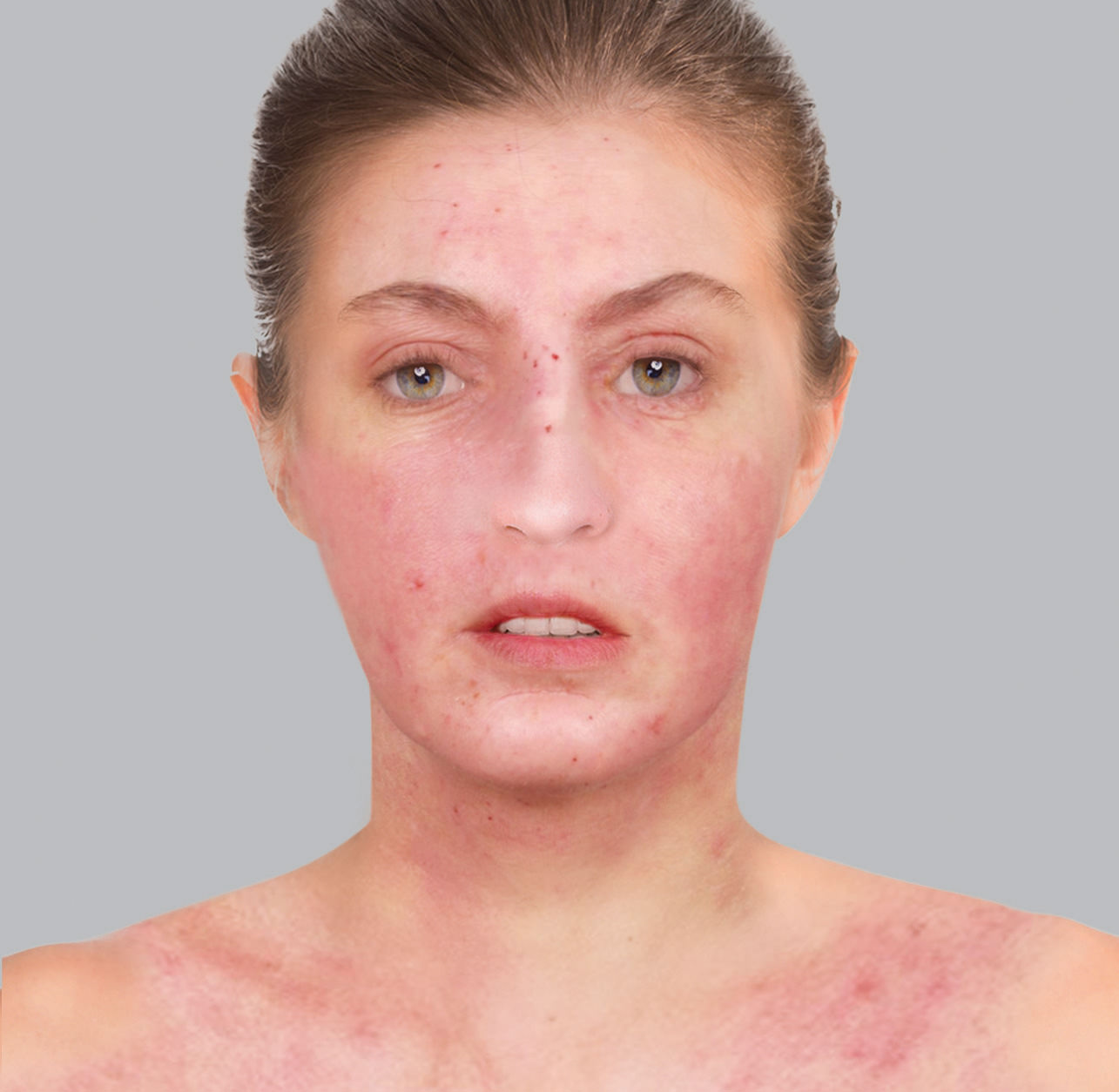 Atopic eczema symptoms: red patches or erythema