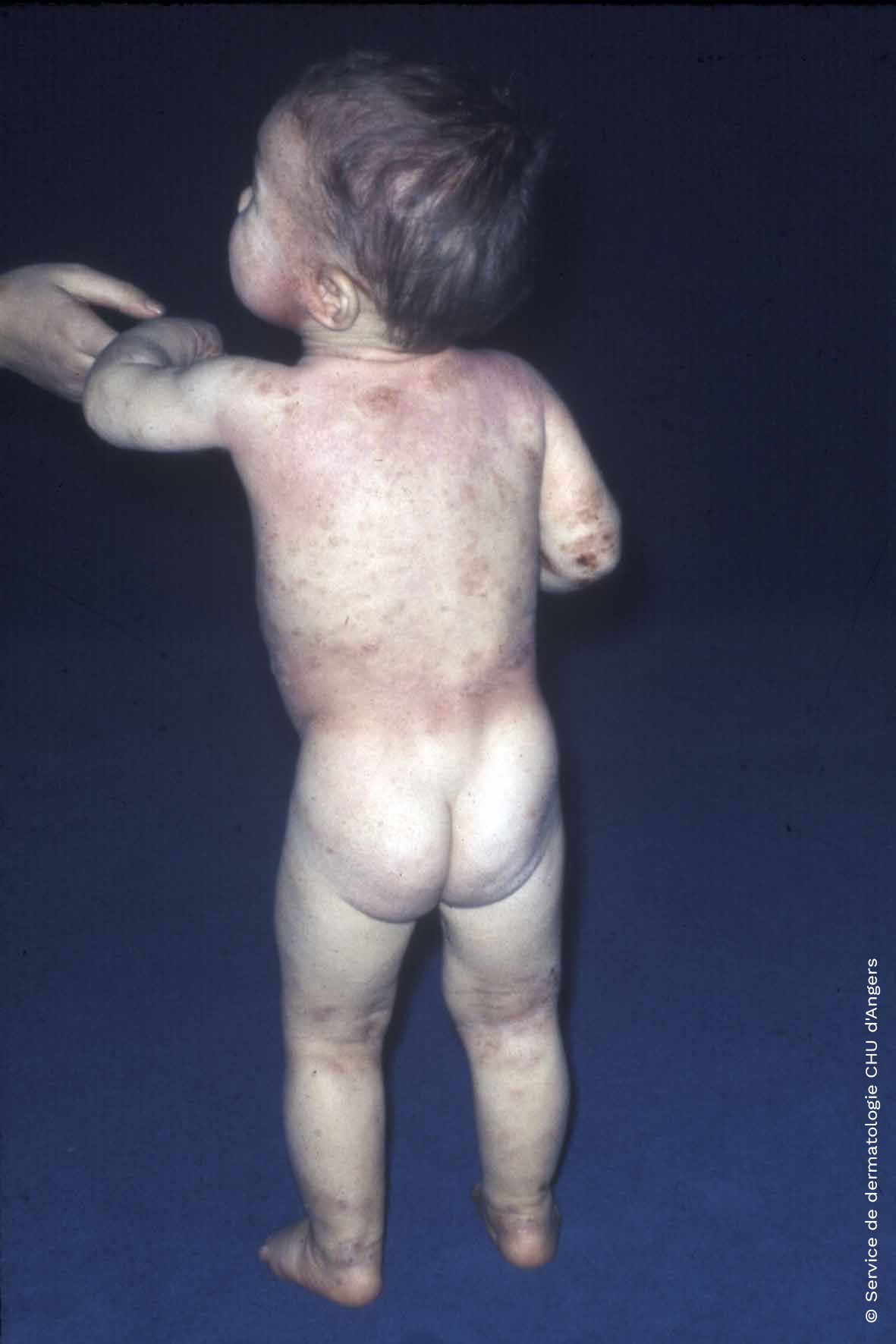 Eczema atópico en el tronco y los pliegues