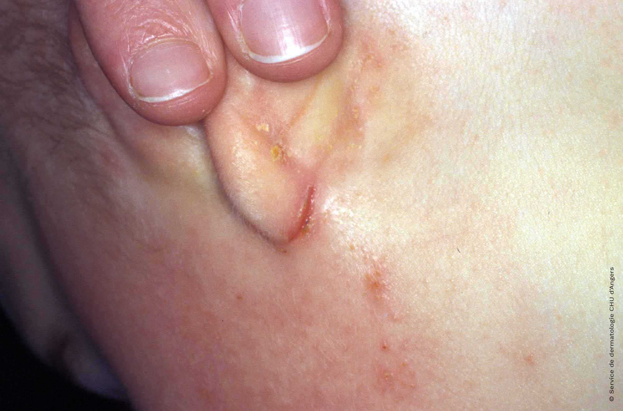 Eczema atópico en la oreja: fisura debajo de la aurícula