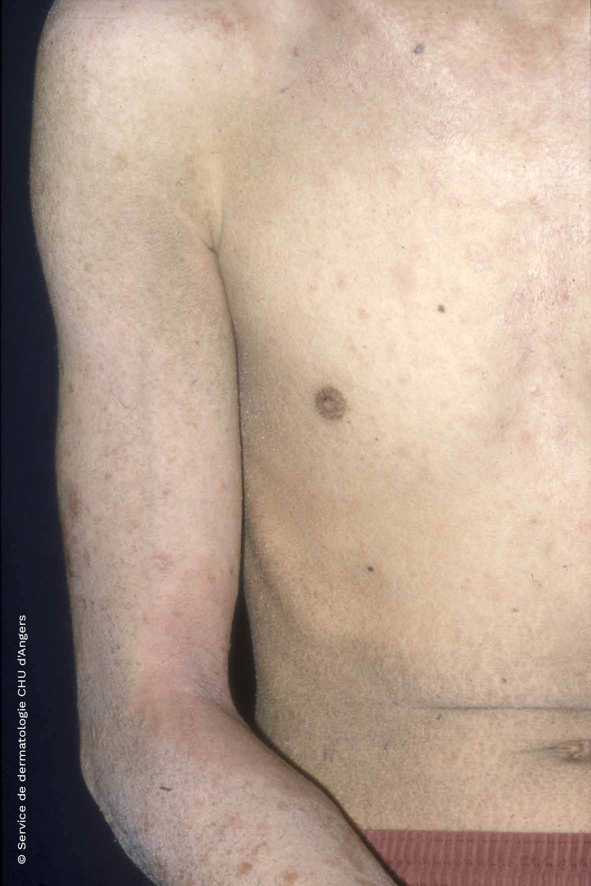 O eczema atópico do busto