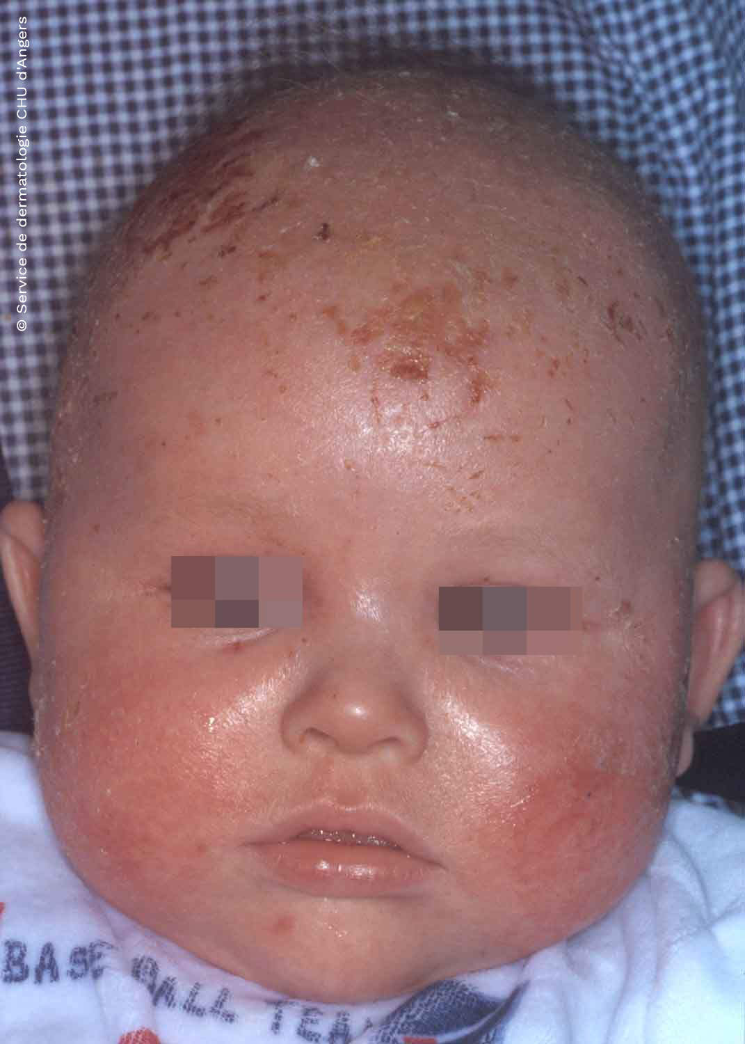 Atopische Dermatitis bei Kindern