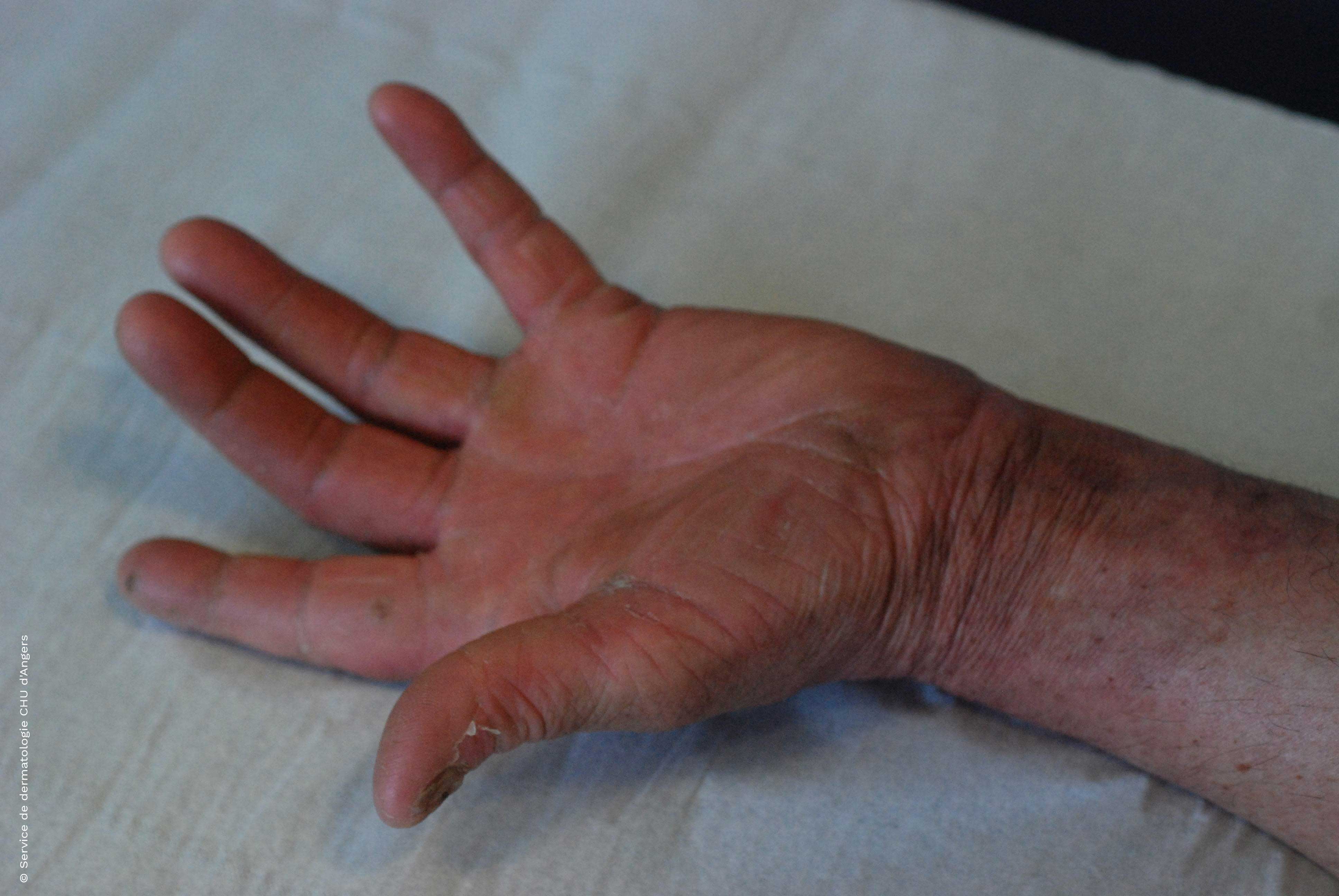  Dermatophytie an der Hand nach antimykotischer Behandlung
