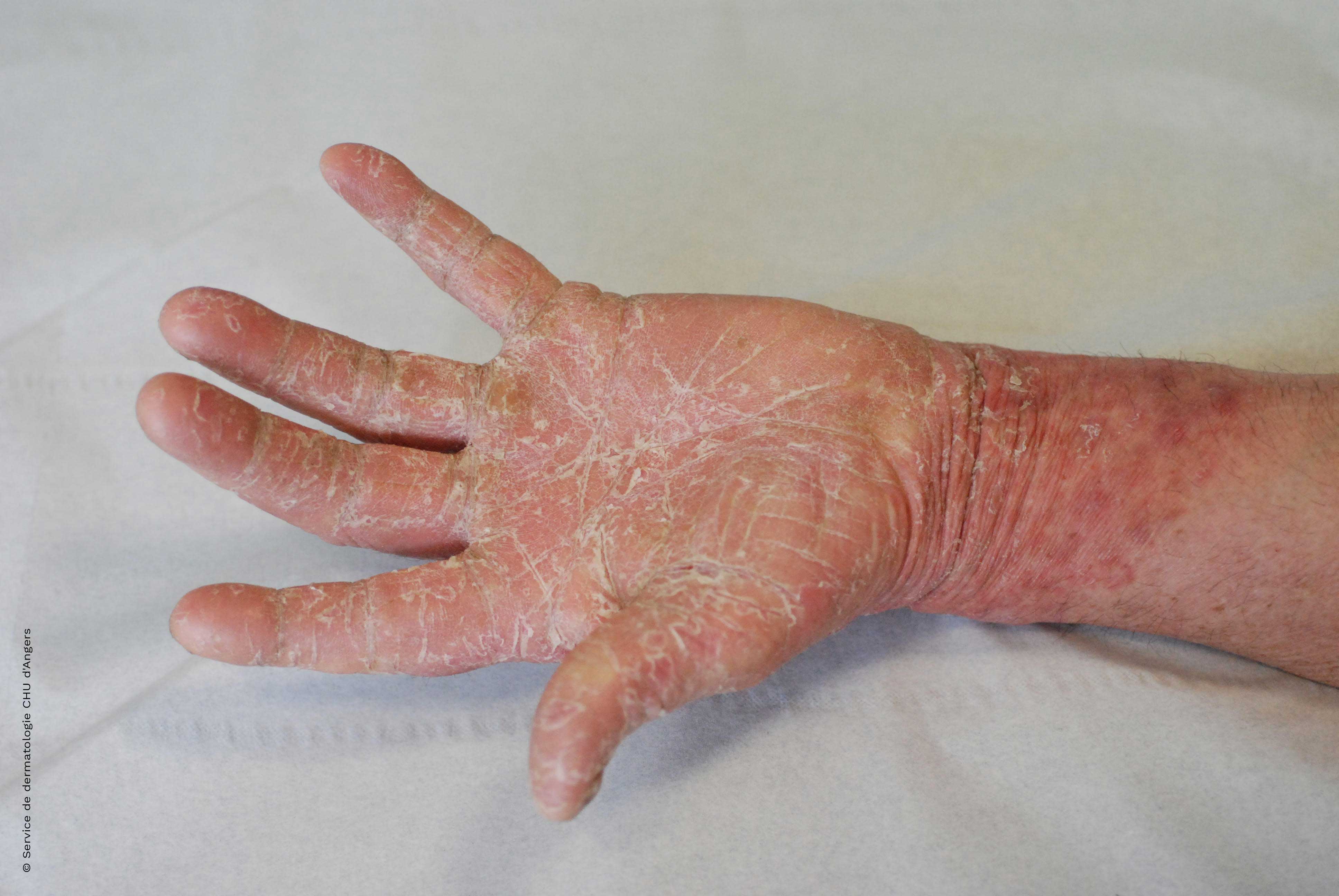 Dermatofitosis en la mano diagnóstico diferencial eczema