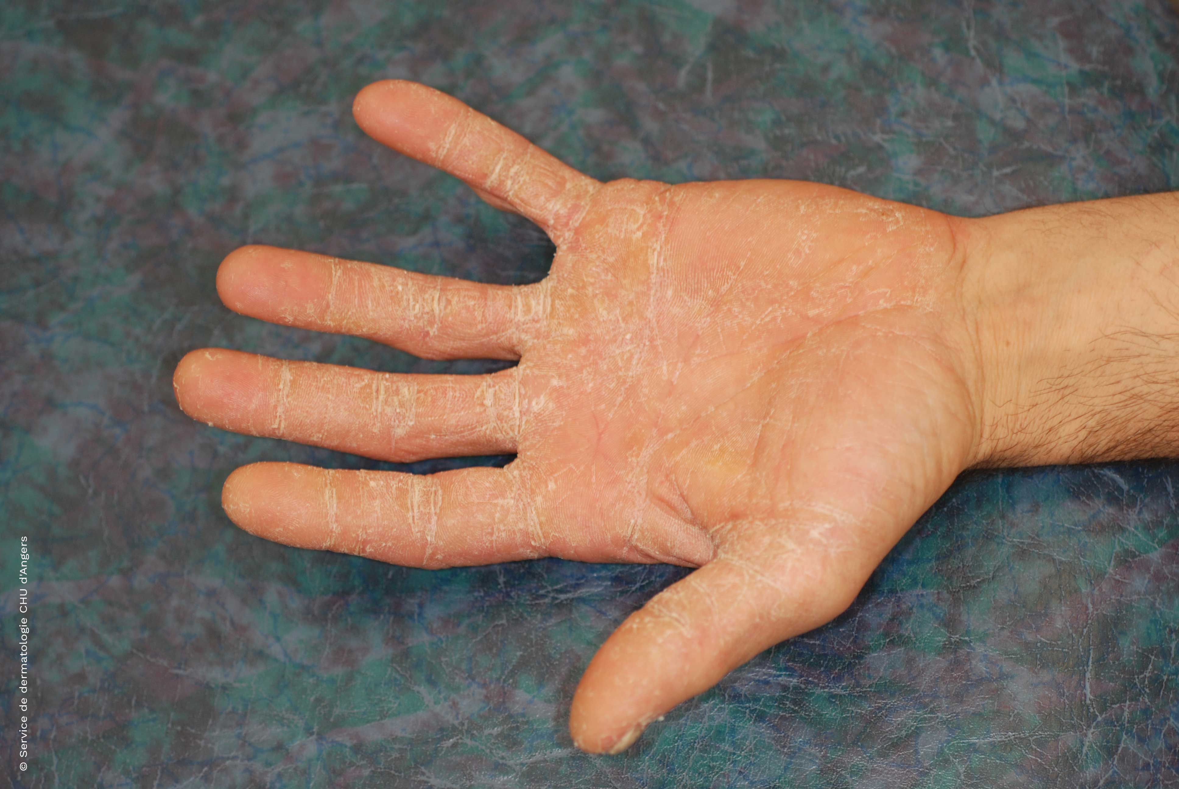 Dermatofitosi del palmo della mano diagnosi differenziale eczema