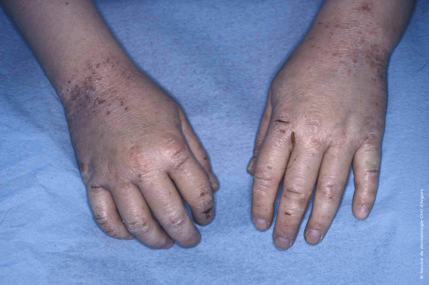 Atopic dermatitis of the hands of a child