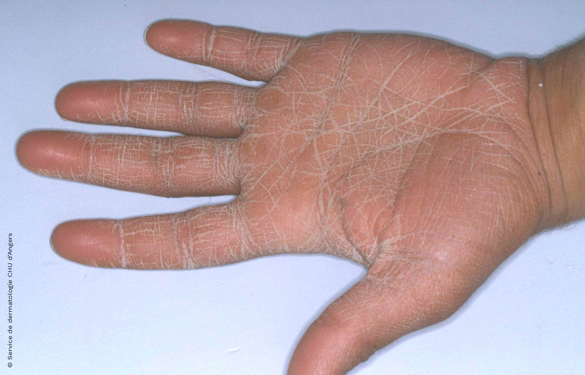 Dermatitis irritativa en las manos
