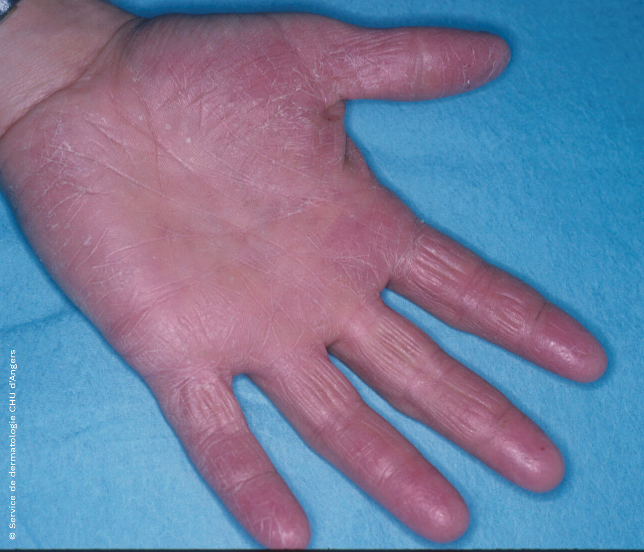 Eczema irritativo da mão