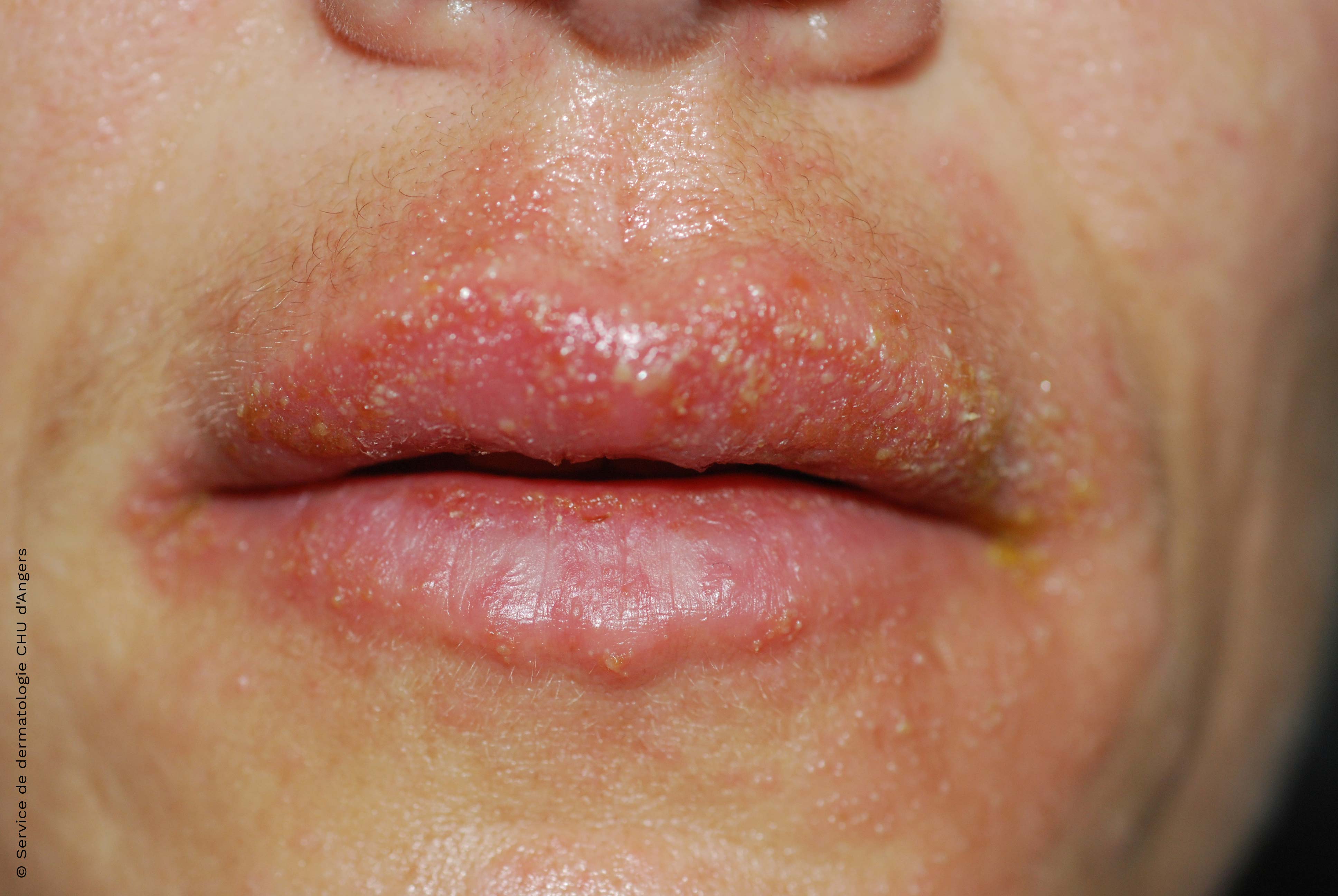 Acute lip eczema