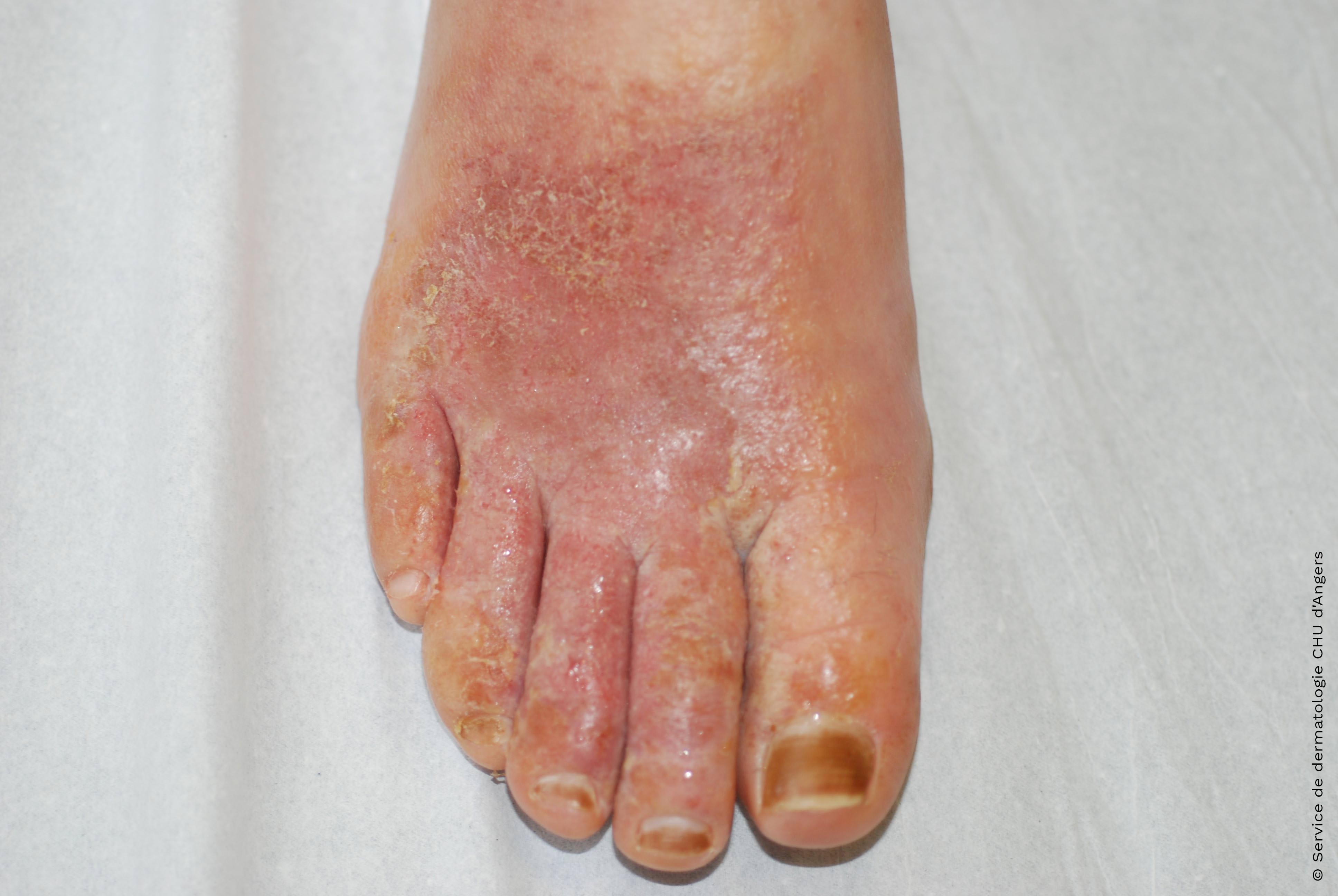 Eczema de contacto agudo en el pie debido al aceite de árbol de té