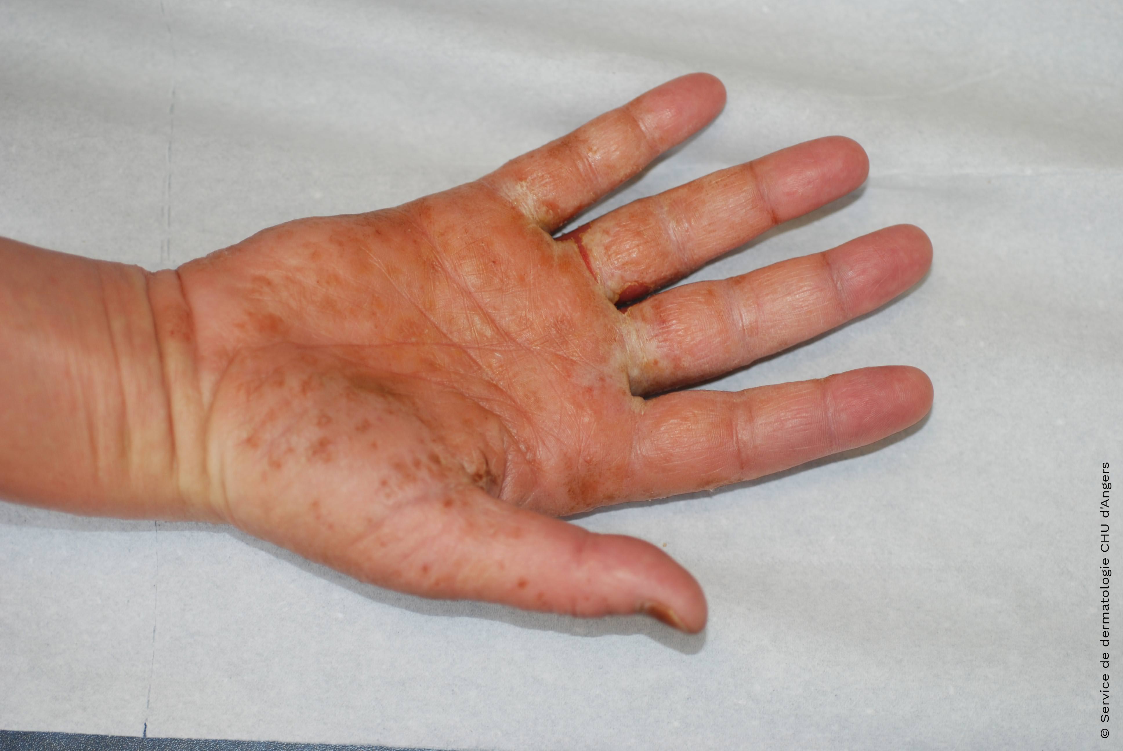 Acute allergic eczema of the palms of the hands