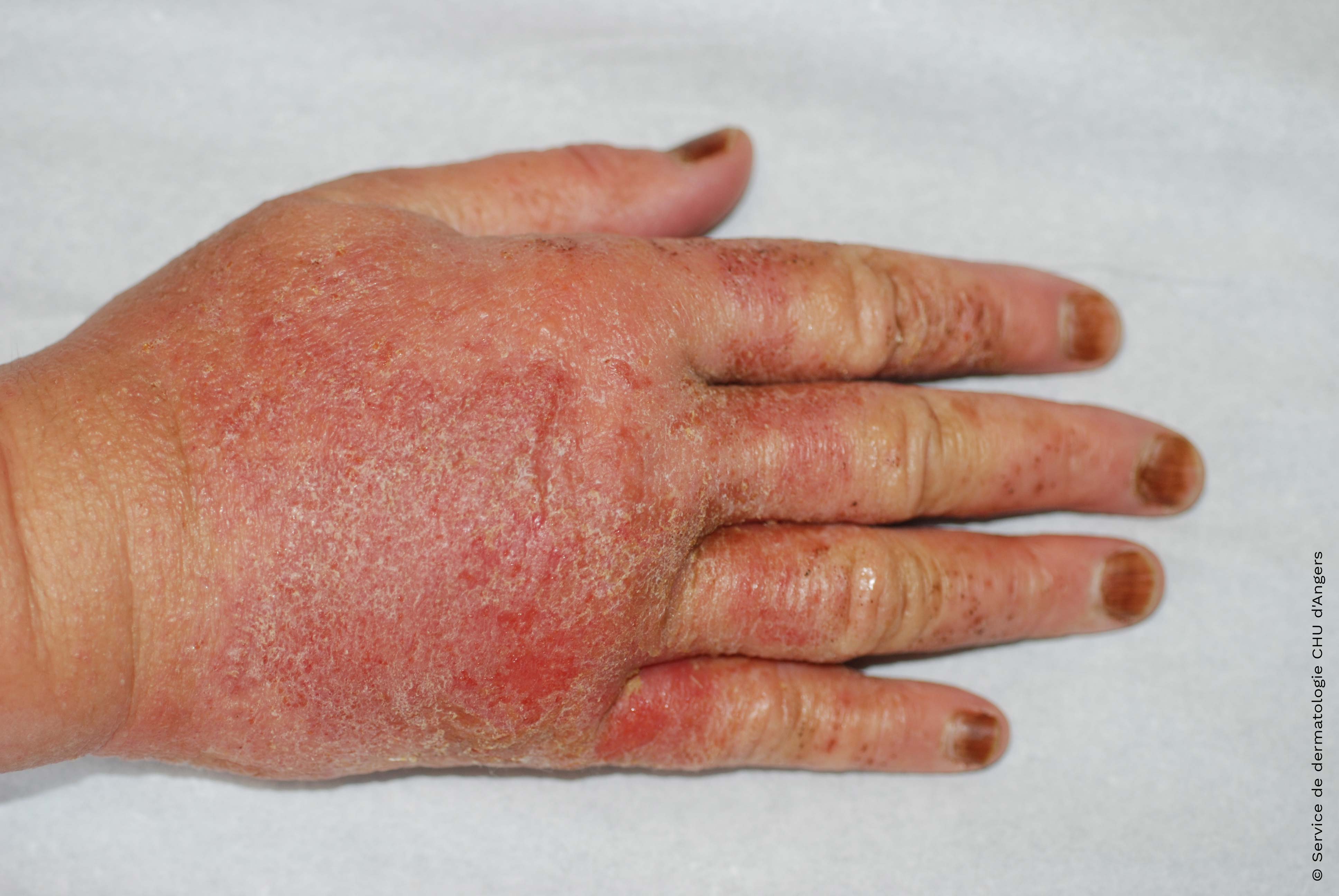 Eczema alérgico agudo en las manos debido al aceite de árbol de té