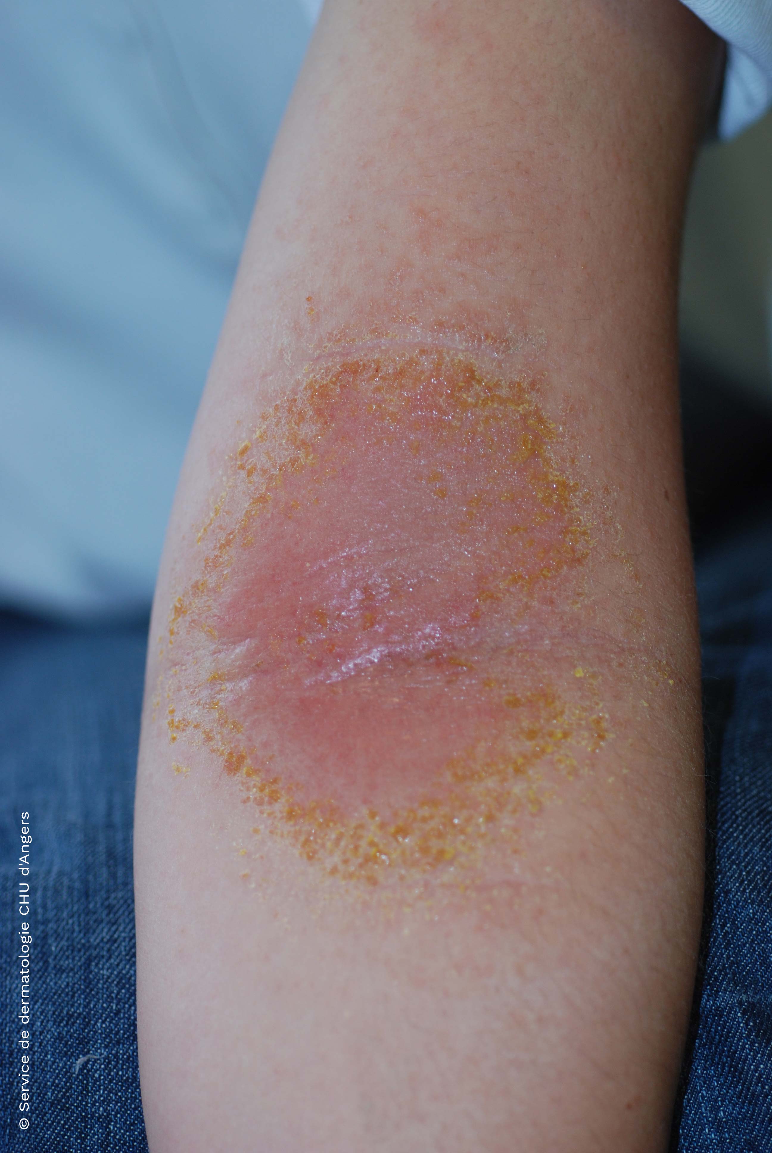 Eczema alérgico de contato dos braços
