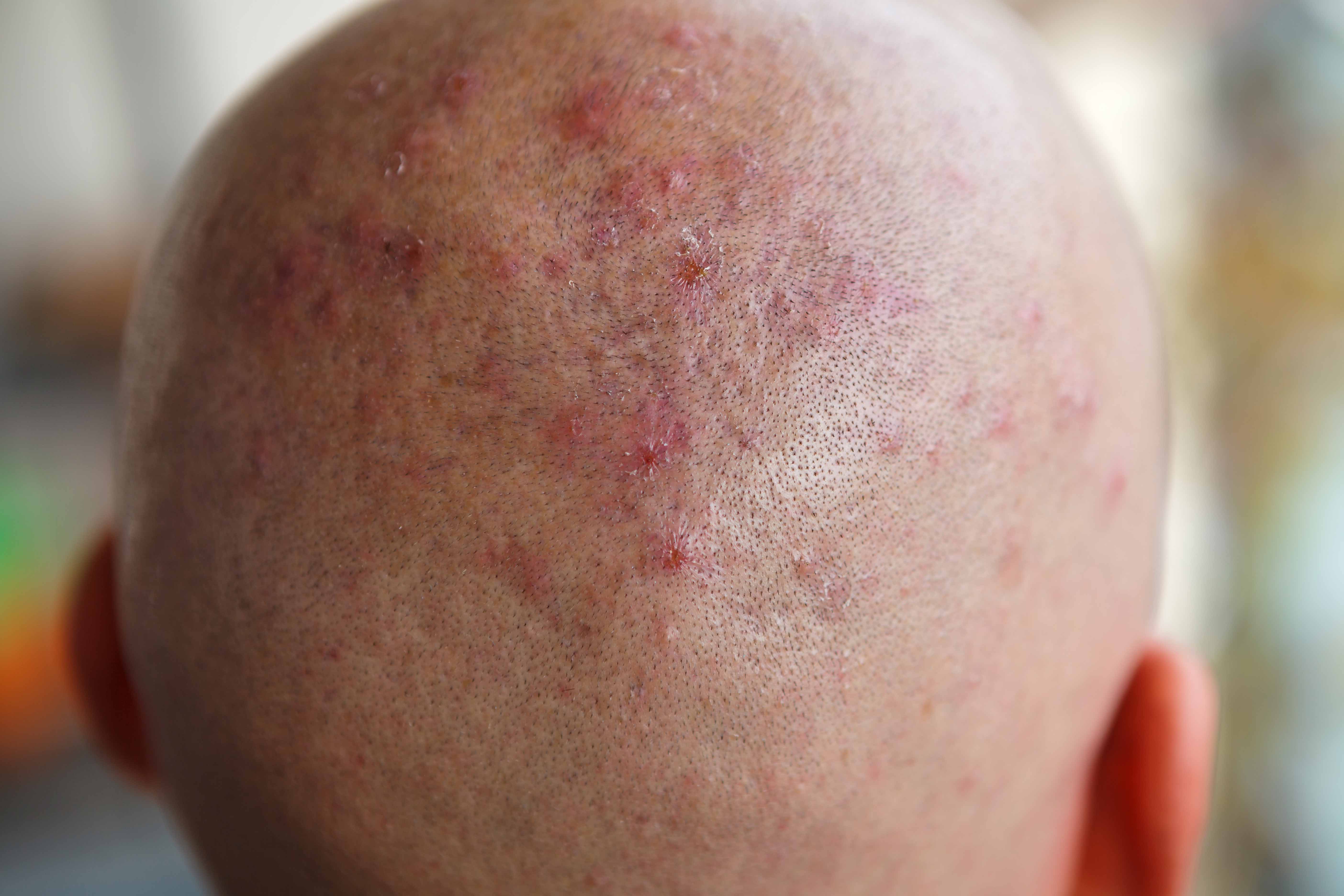 Eczema alérgico do couro cabeludo