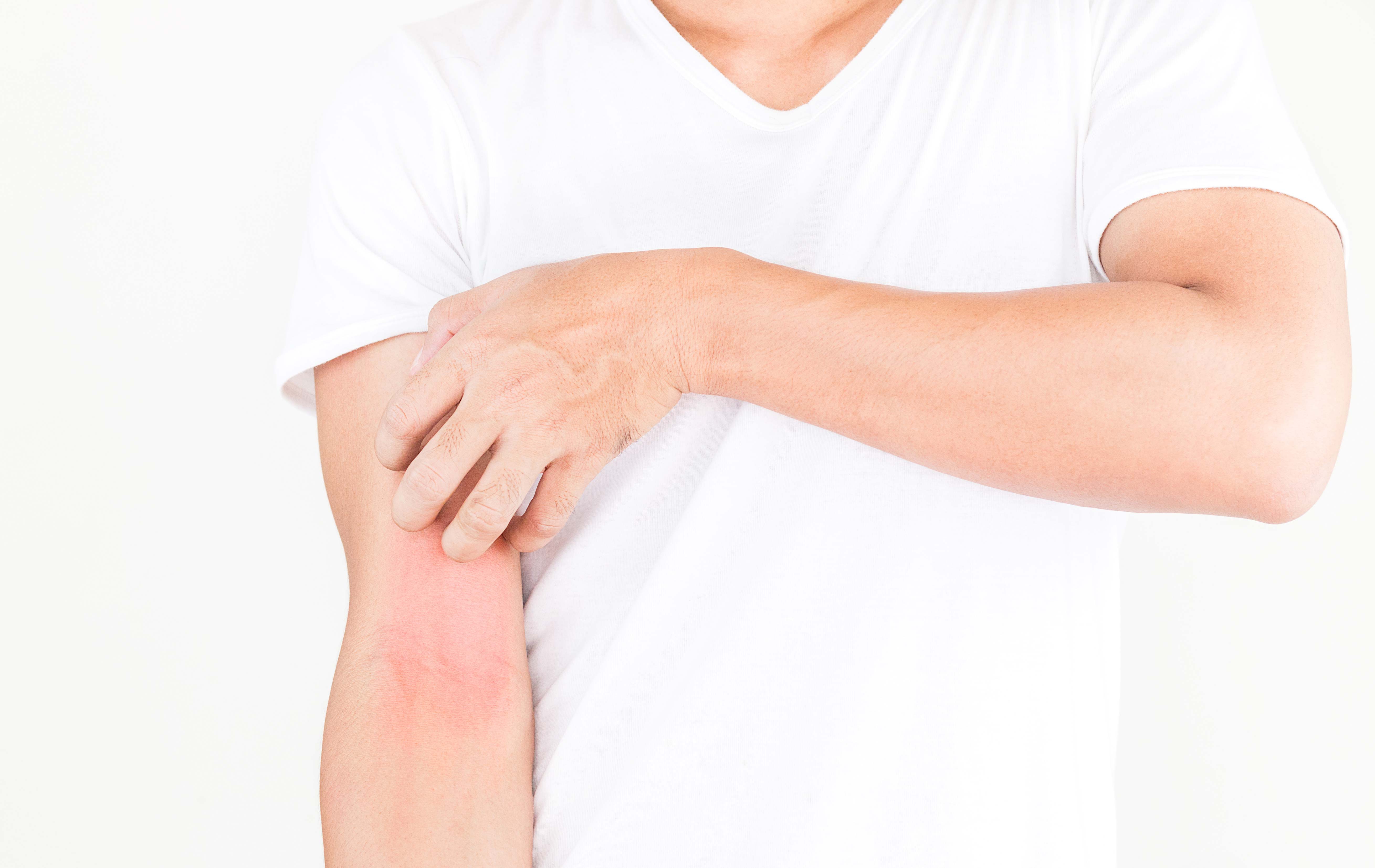 Eczema atopico delle braccia