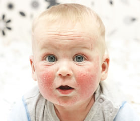 Eczema atópico en la cara