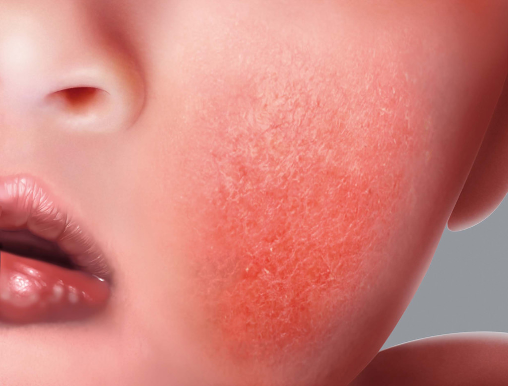 Atopic eczema symptoms : Red patches (Erythema)