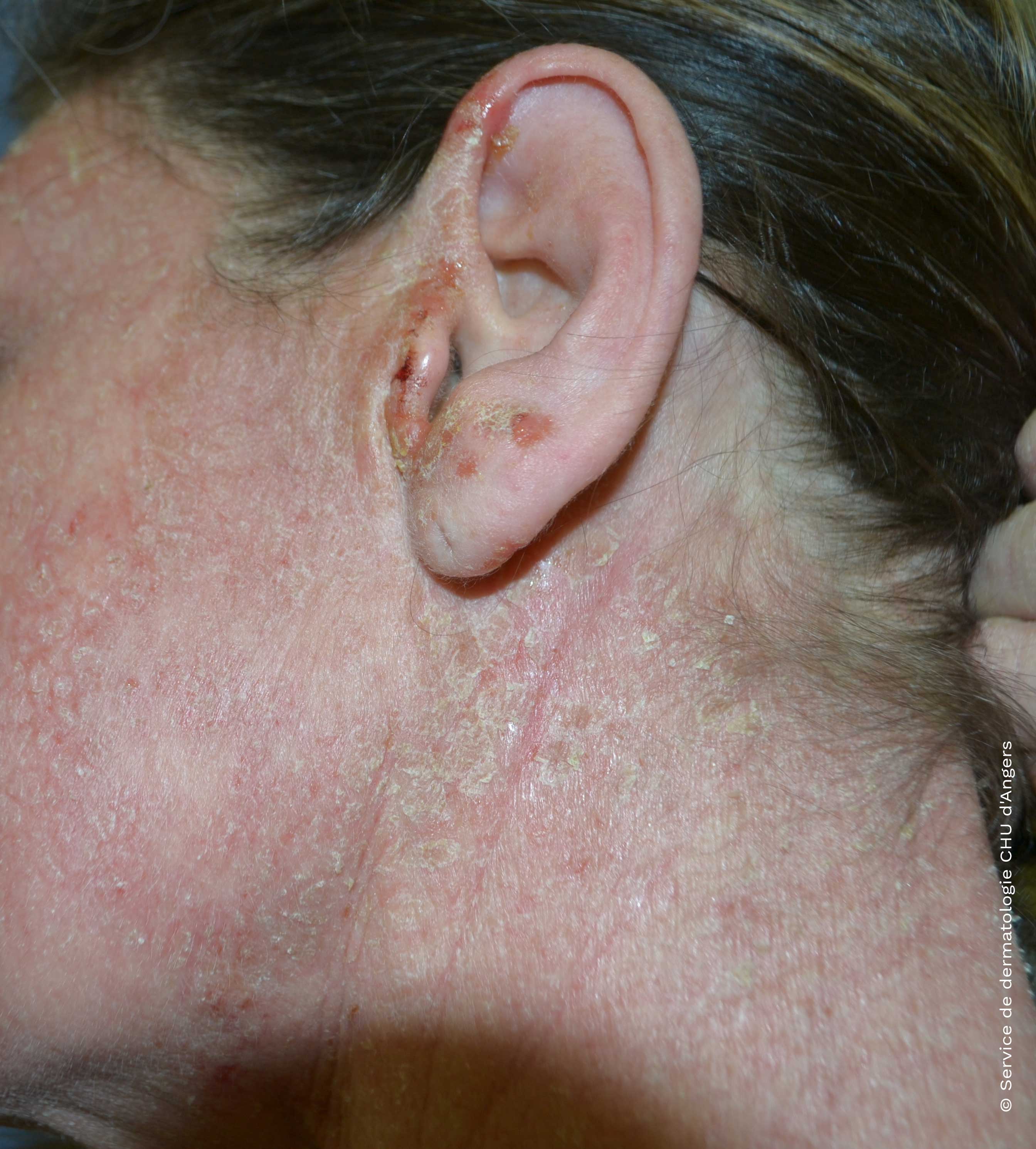 Eczema atópico en la cara y el cuello