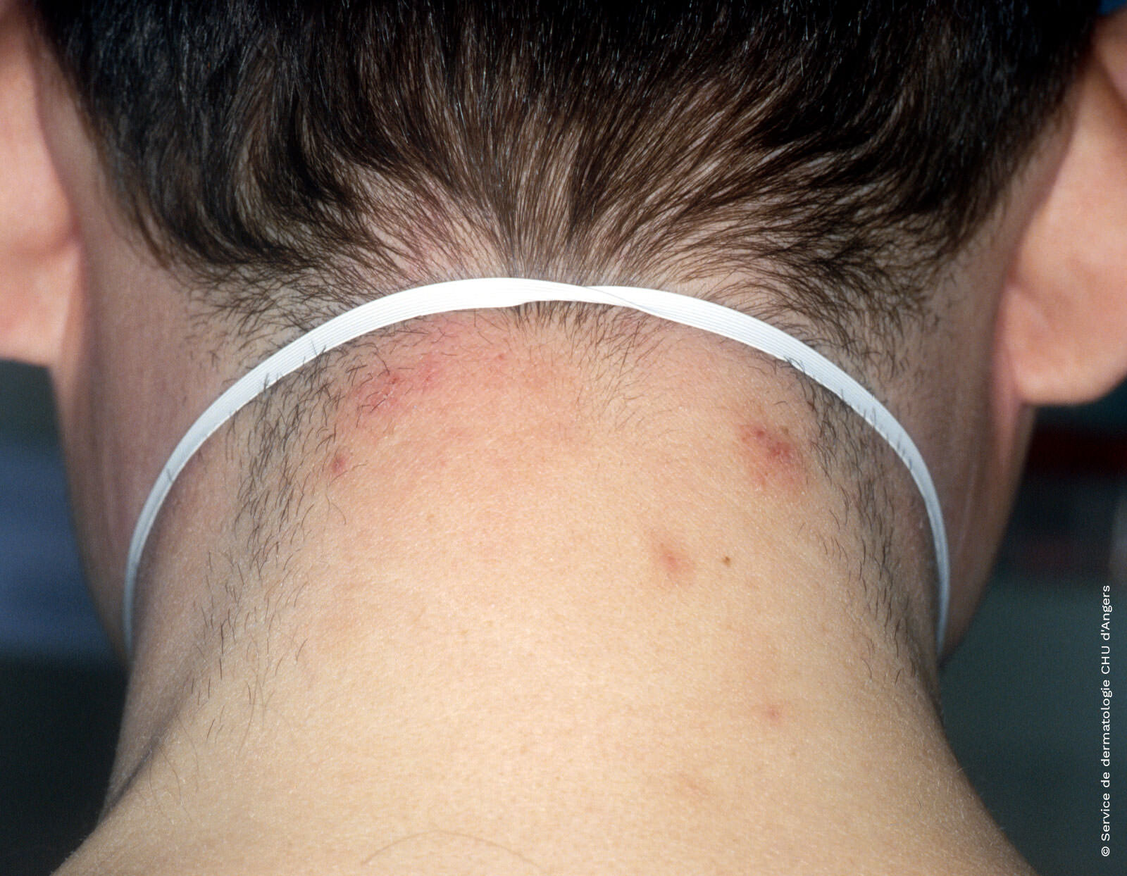 Eczema de contacto debido al caucho de la goma del pelo