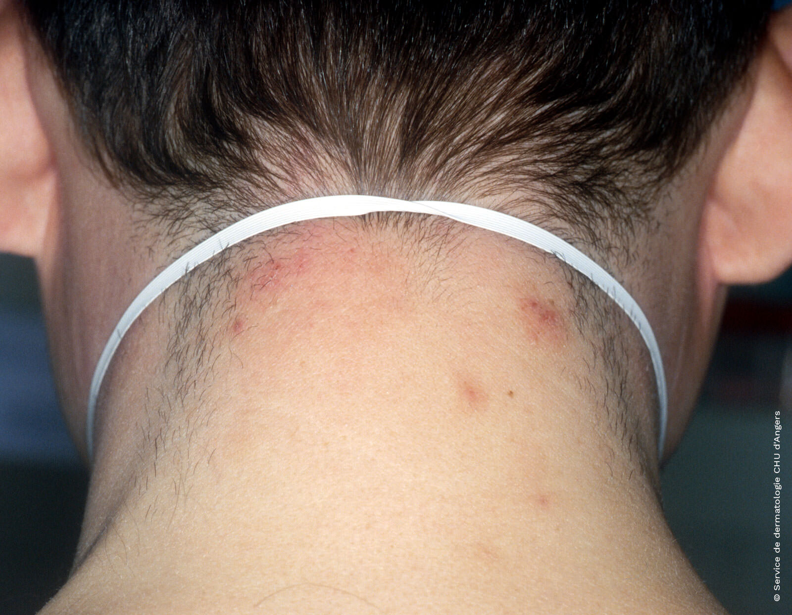 eczema on neck