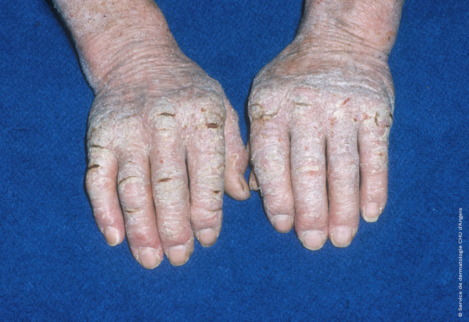 Severe chronic hand eczema