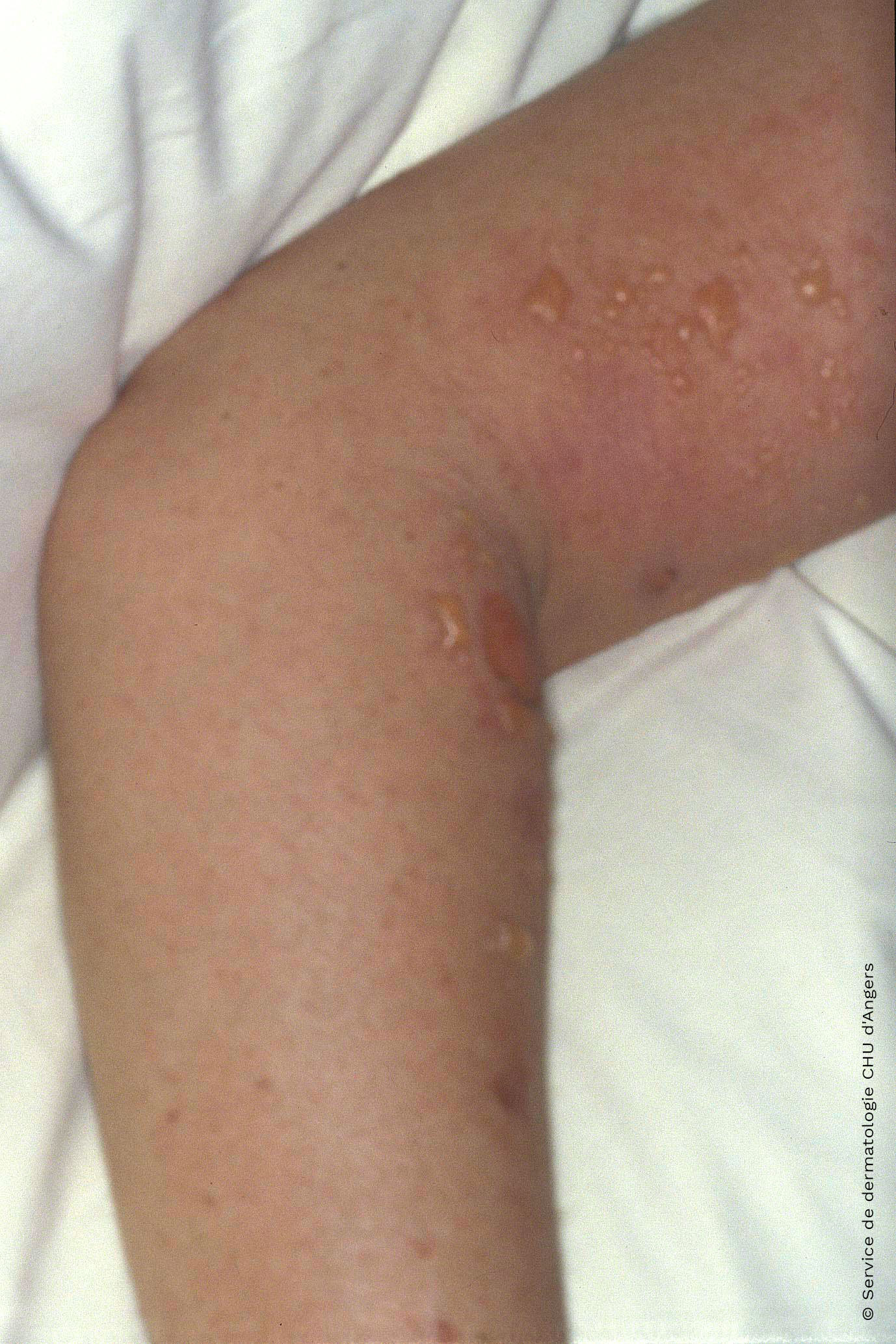 Eczema de contacto agudo en el brazo debido al ketoprofeno