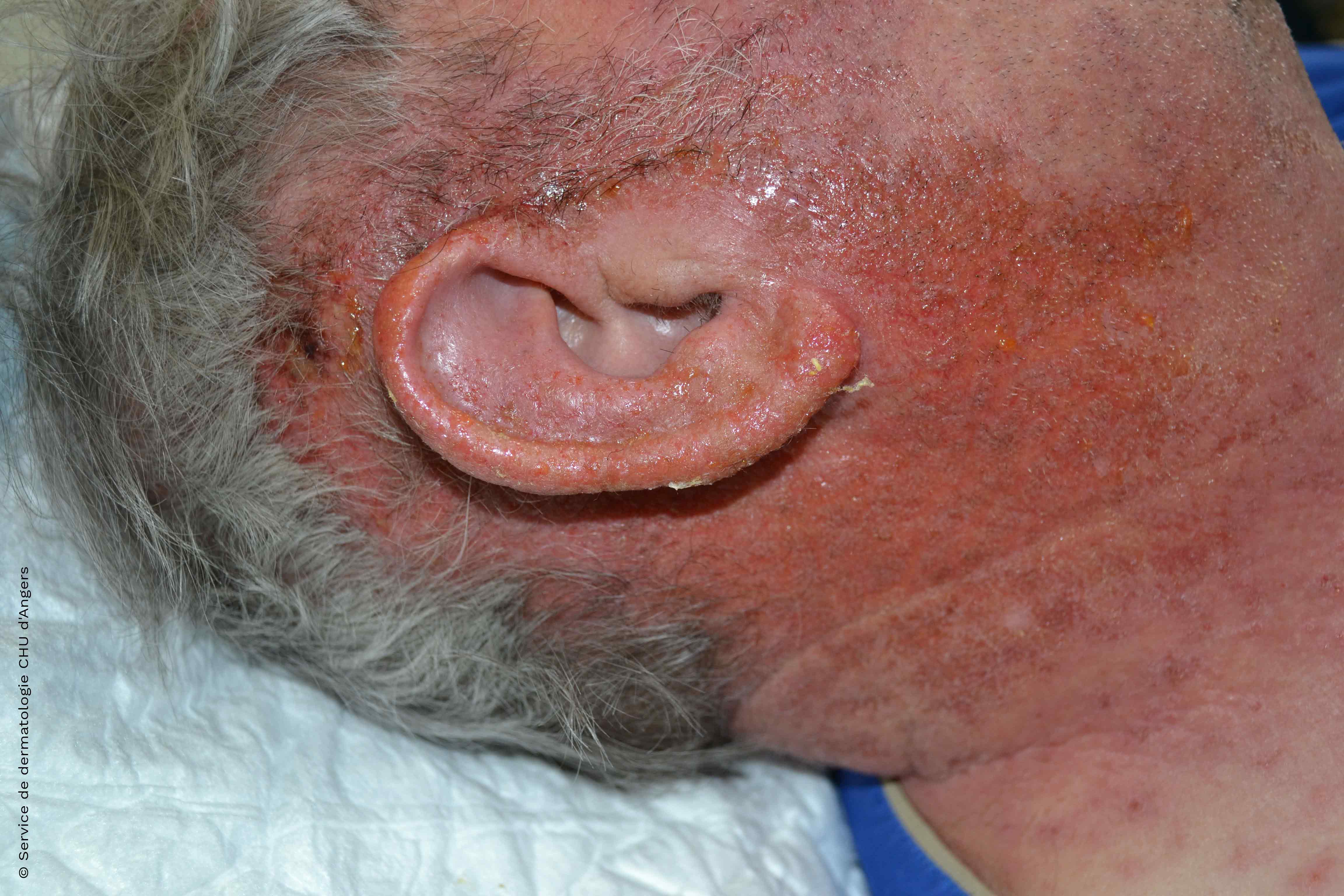 Akutes Kontaktekzem im Gesicht und am Ohr durch ein Antiseptikum