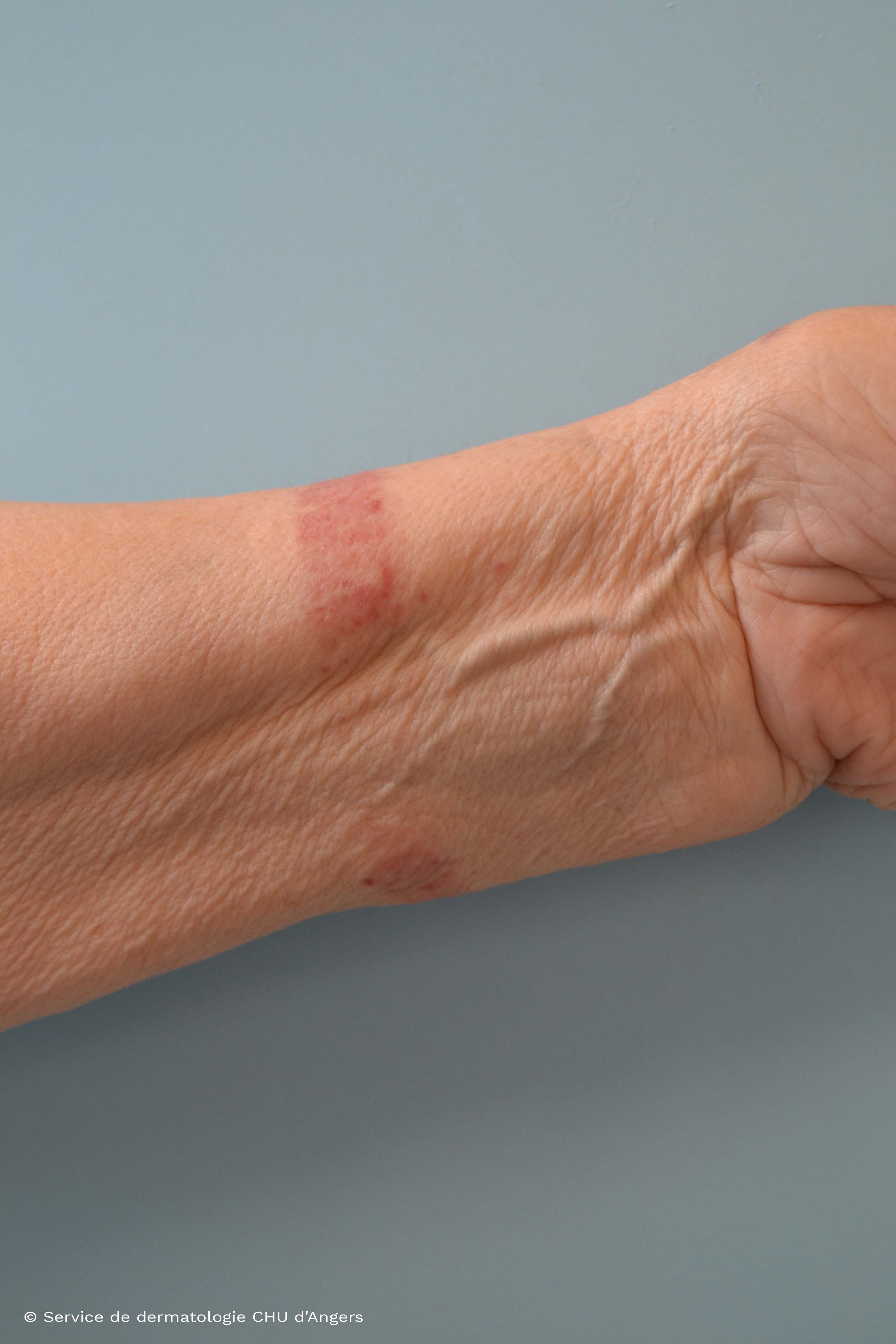 Eczema da contatto causato dal cinturino dell'orologio (nichel)  
