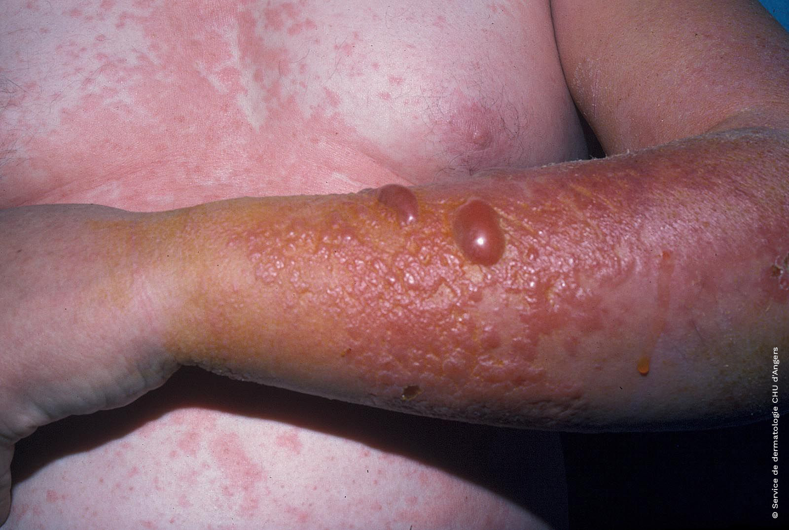 Eczema de contacto bulloso en brazo con difusión debido a la esencia de trementina