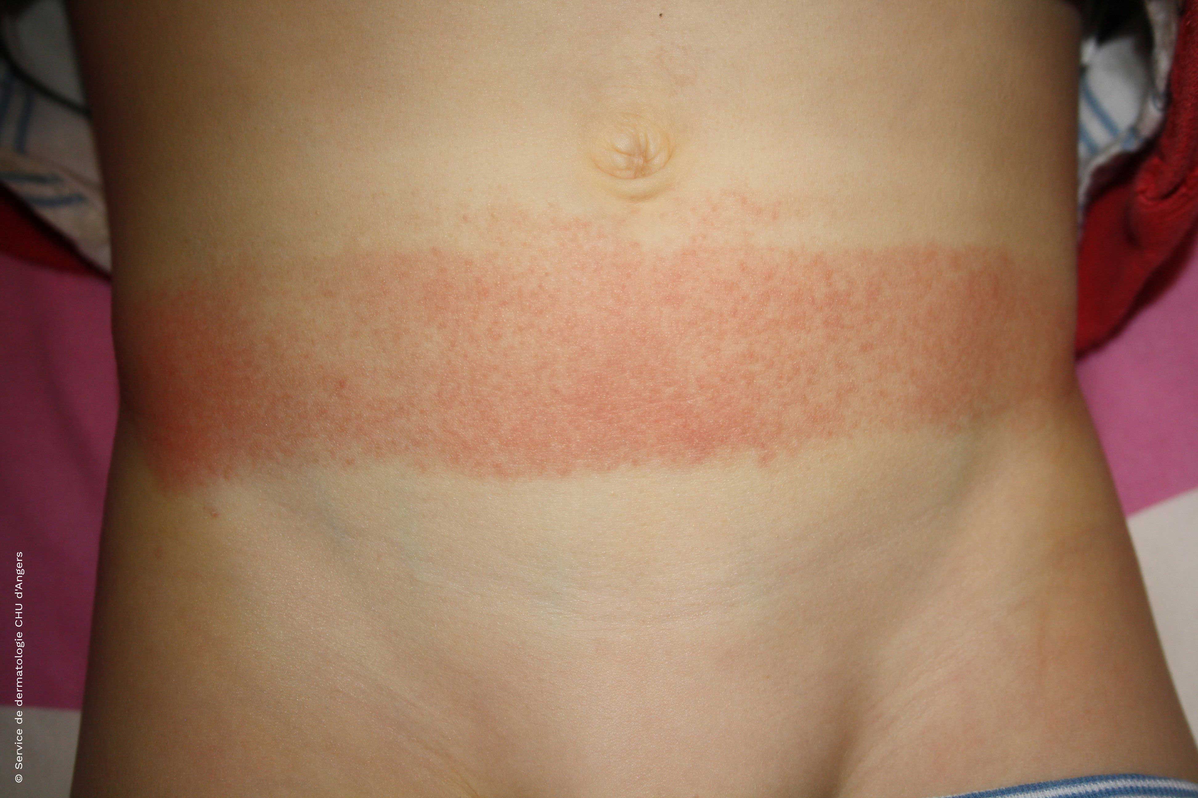 Eczema de contacto infantil en el abdomen debido al caucho