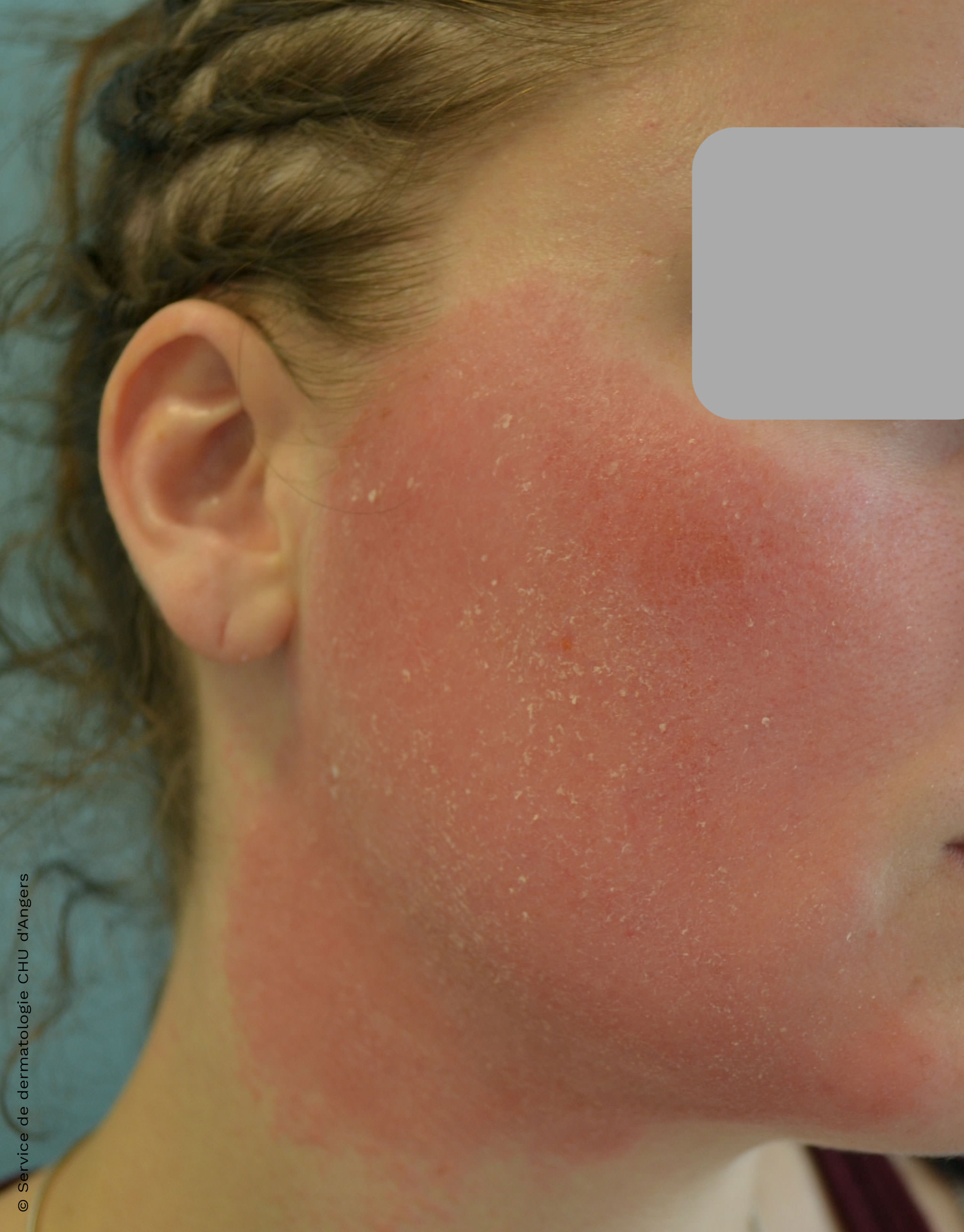 Eczema de contacto en la cara debido a un antimicótico