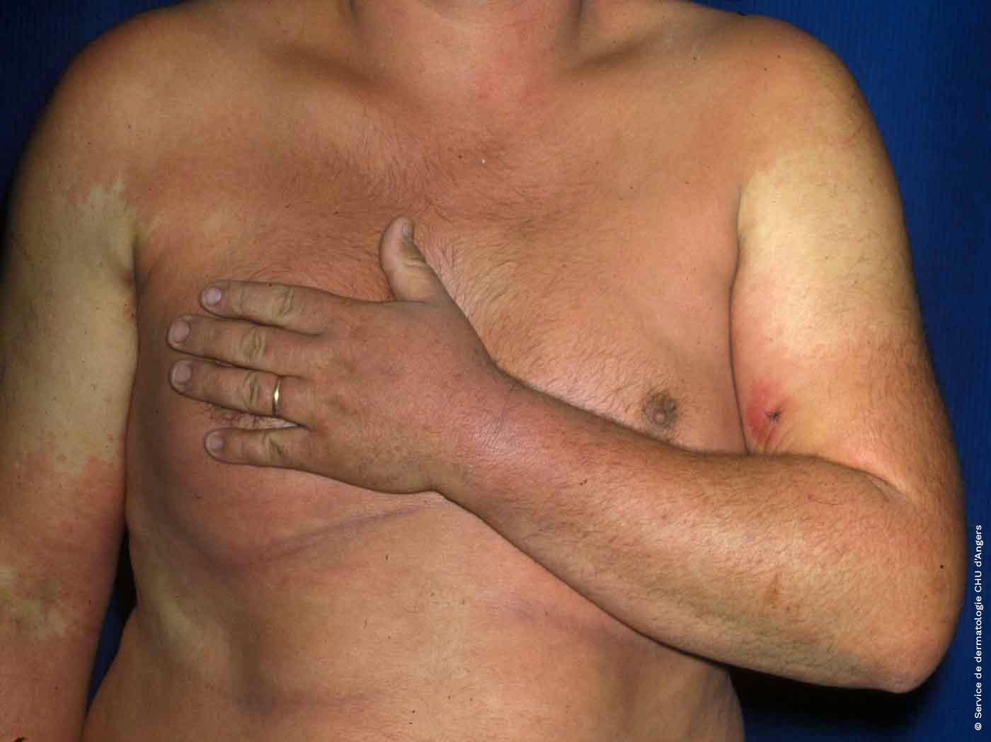 Eczema de contacto del busto debido al bufexamac