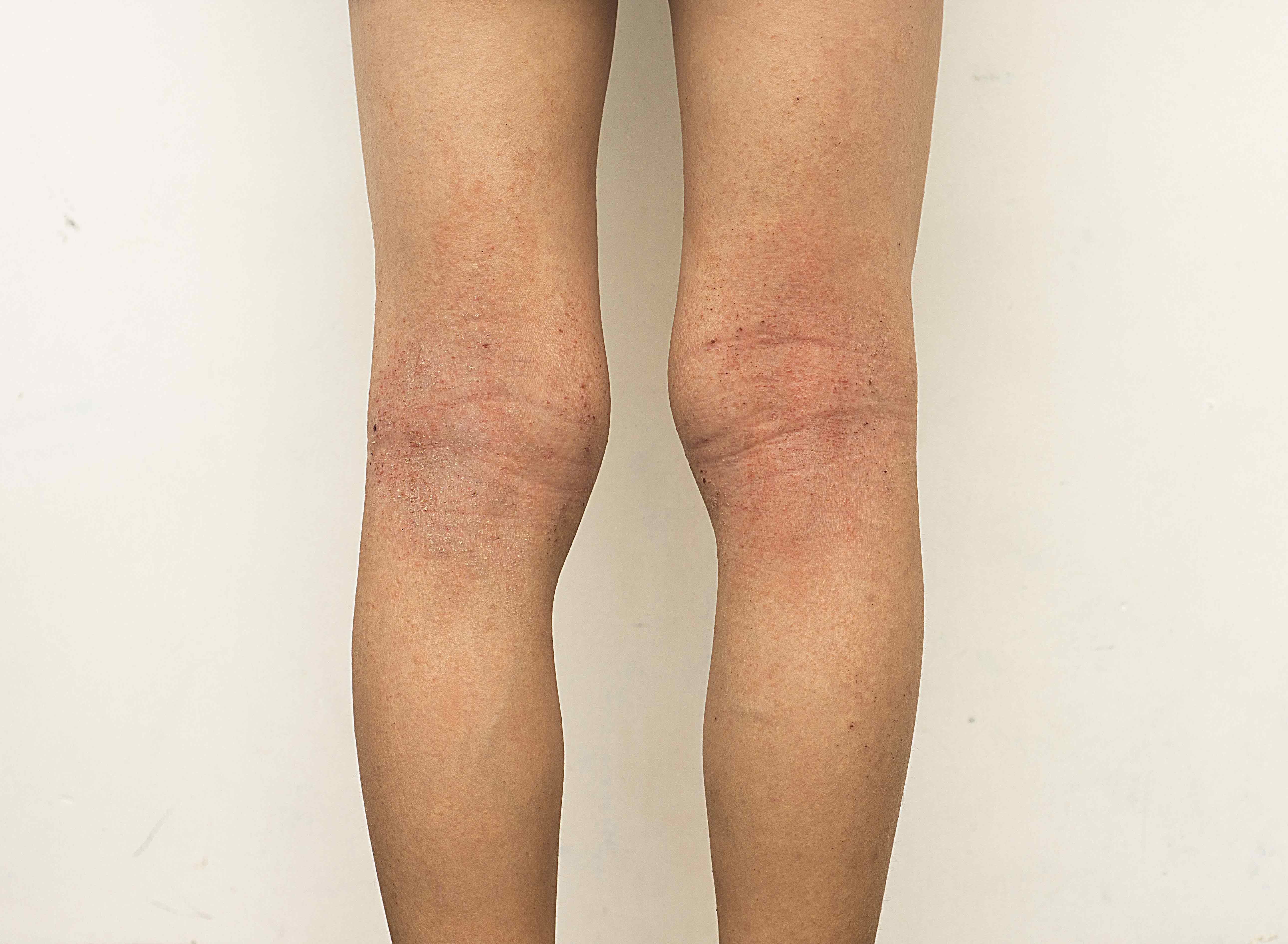 Eczema atópico en los pliegues de las rodillas